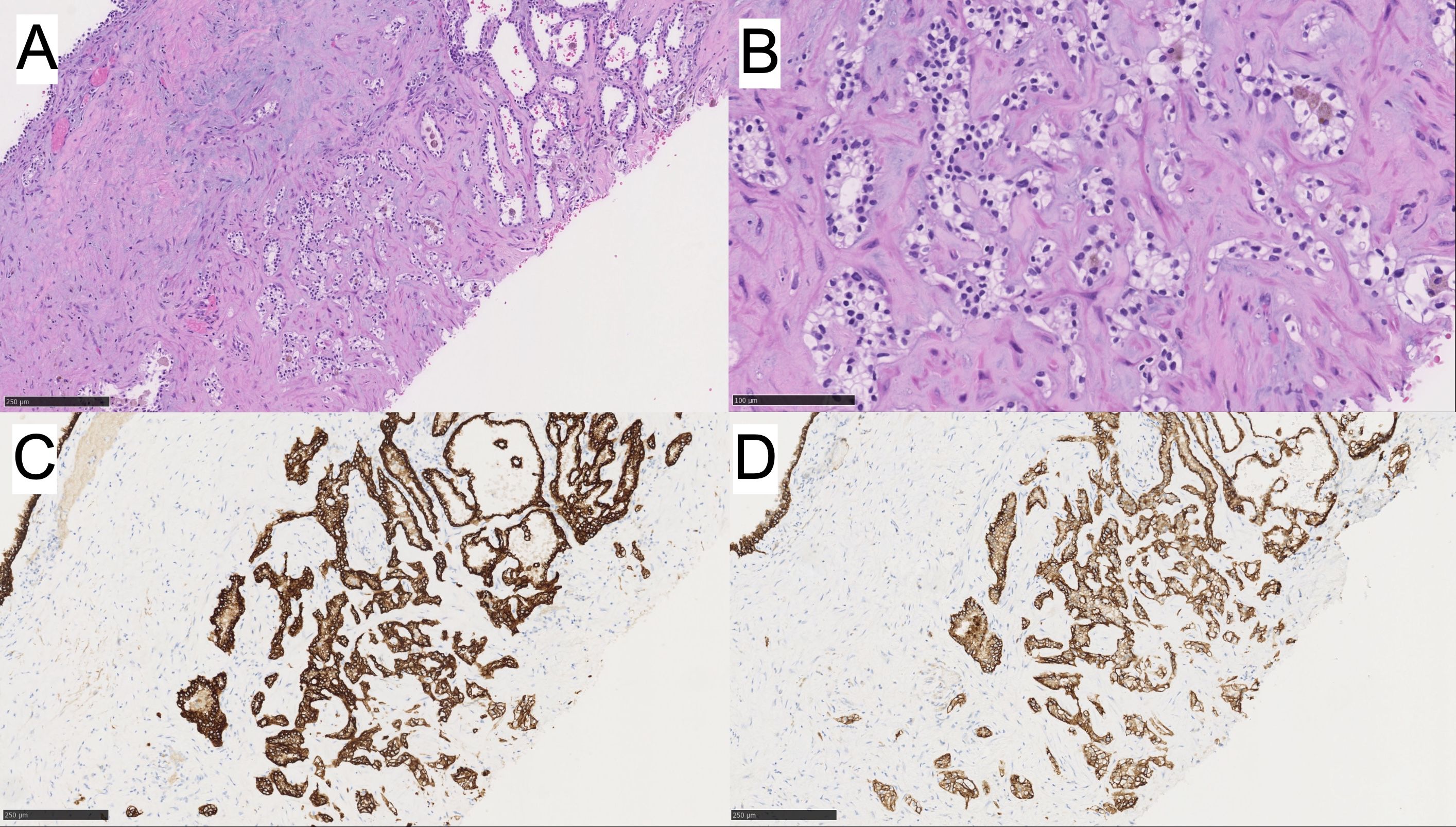 Histological analysis showing four panels of tissue samples. Panel A and B are stained with hematoxylin and eosin, displaying glandular structures and stromal tissue. Panel C and D are immunohistochemically stained, highlighting distinct protein expression with brown labeling against a light background. Each panel varies in magnification.