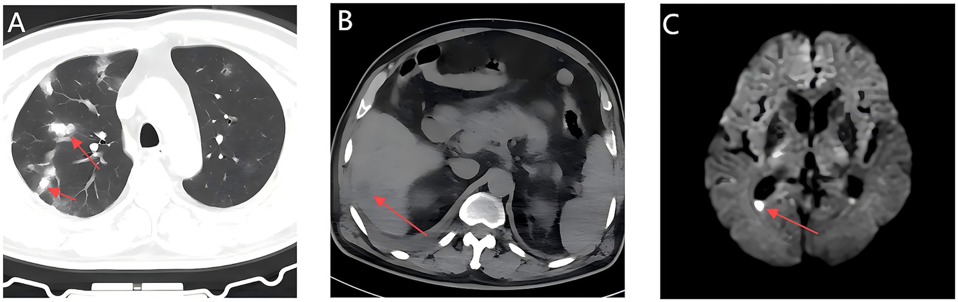 A series of three medical scans labeled A, B, and C. A shows a chest CT scan with arrows indicating areas in the lungs. B displays an abdominal CT scan with an arrow pointing to a specific region. C is a brain MRI with an arrow highlighting an area of interest.