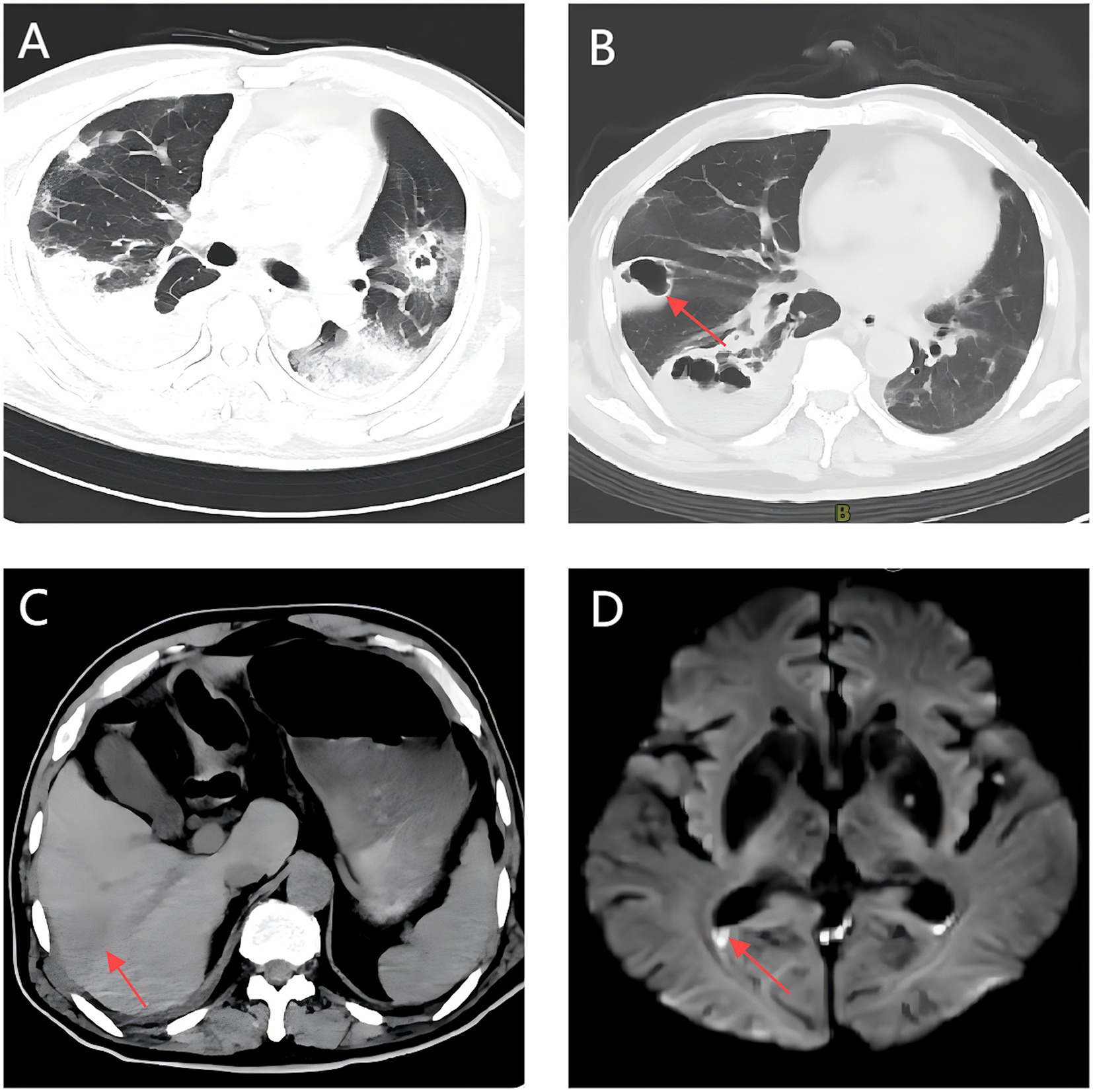 Four medical images labeled A, B, C, and D:A: CT scan of the chest showing abnormal lung patterns.B: CT scan of the chest with a red arrow pointing to a dark area, possibly indicating a lesion or abnormality.C: CT scan of the abdomen with a red arrow highlighting an area on the liver.D: MRI of the brain with a red arrow indicating a region that may show abnormalities.