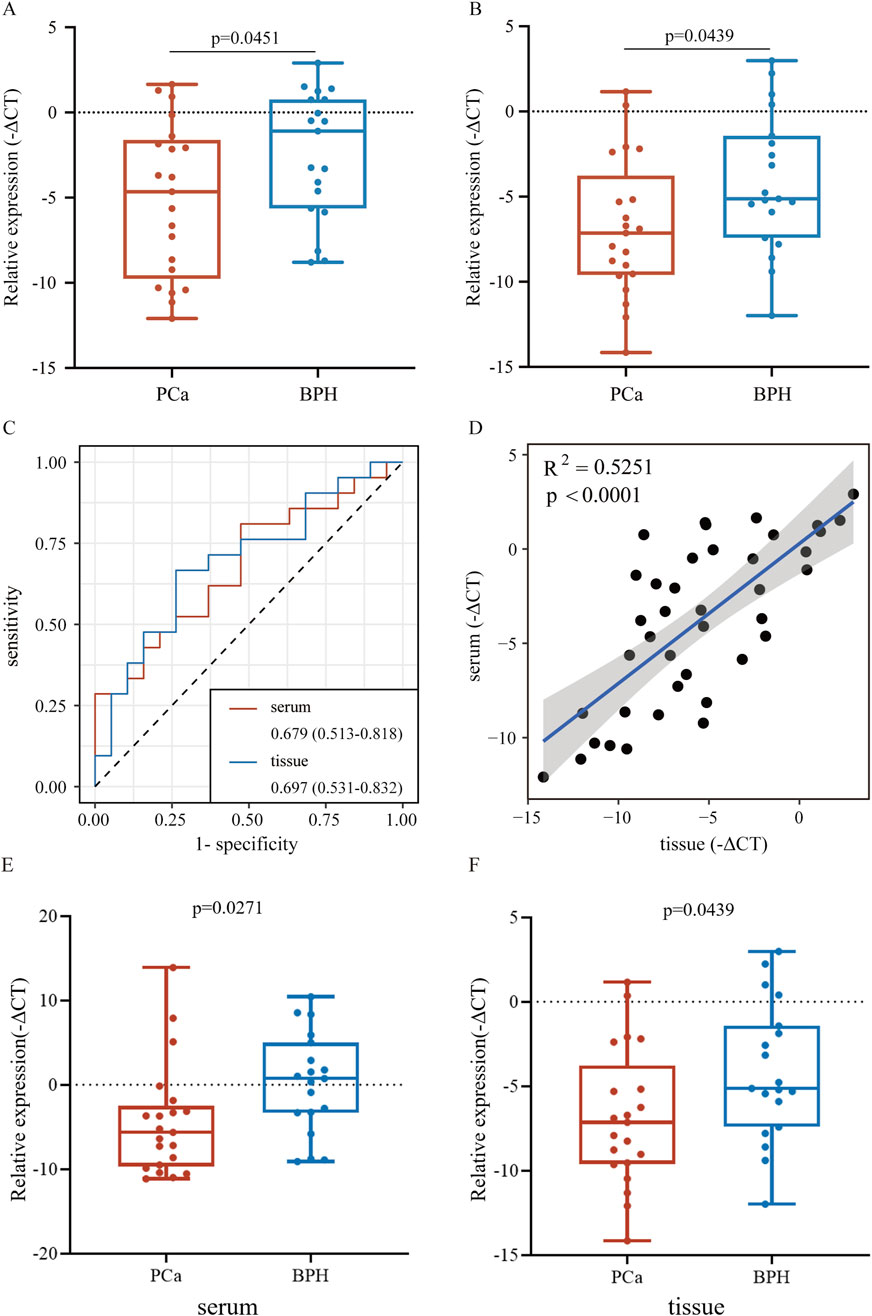 Composite image with multiple panels showing data analysis:A. Box plot comparing relative expression (ΔCT) between prostate cancer (PCa) and benign prostatic hyperplasia (BPH), p-value = 0.0451.B. Similar box plot for relative expression with p-value = 0.0439.C. ROC curve comparing serum and tissue specificity and sensitivity.D. Scatter plot showing correlation between serum and tissue ΔCT, R² = 0.5251, p < 0.0001.E. Box plot for serum expression, p-value = 0.0271.F. Box plot for tissue expression, p-value = 0.0439.