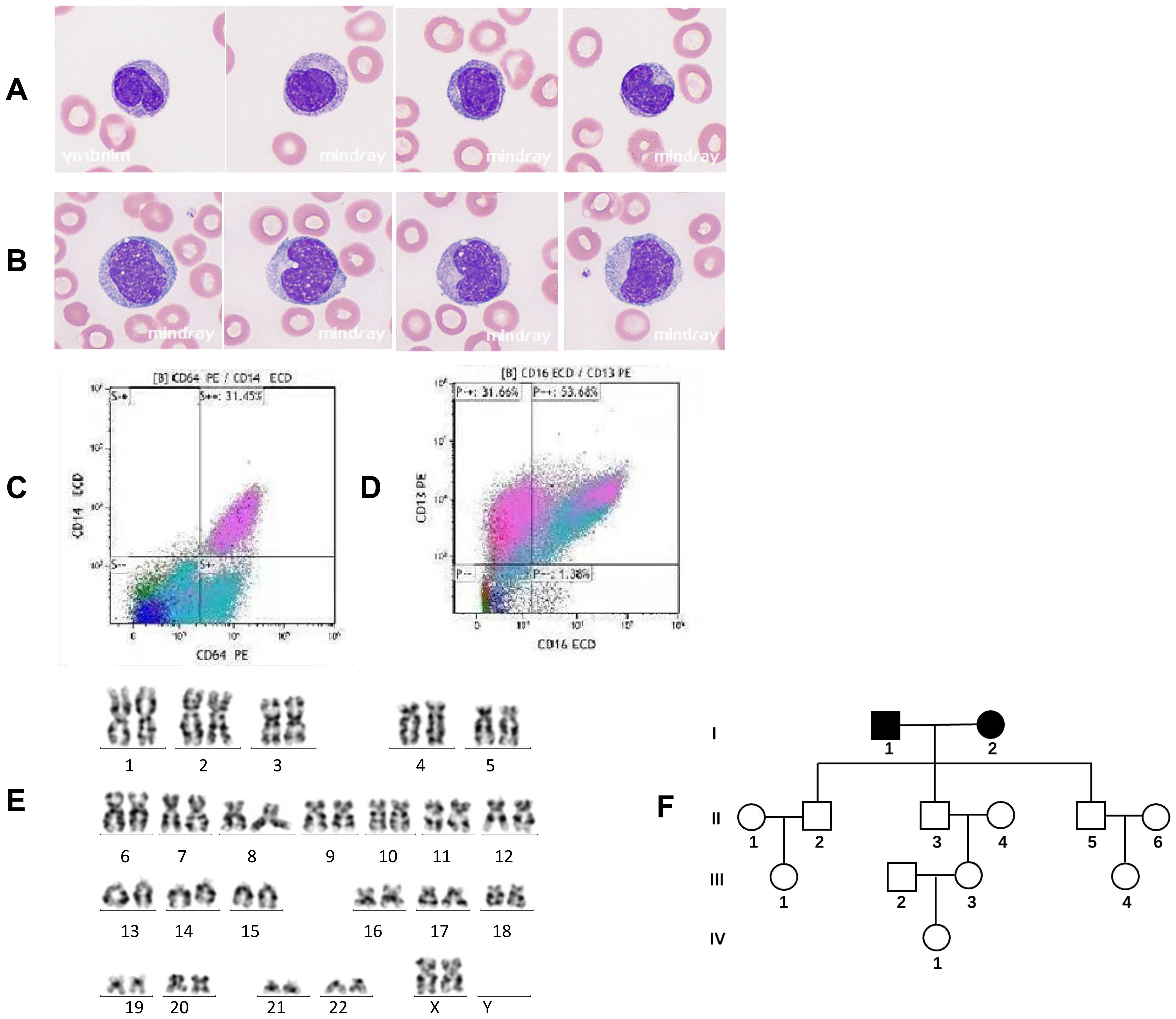 Images arranged in panels A to F. Panel A and B show microscopic images of blood cells with dark purple centers surrounded by pink circles. Panels C and D display scatter plots with colored data points, axis labeled as CD64, CD14 for C, CD16, CD13 for D. Panel E presents chromosome karyotypes labeled one to twenty-two, X, and Y. Panel F has a pedigree chart showing family relationships and shaded symbols indicating affected individuals.