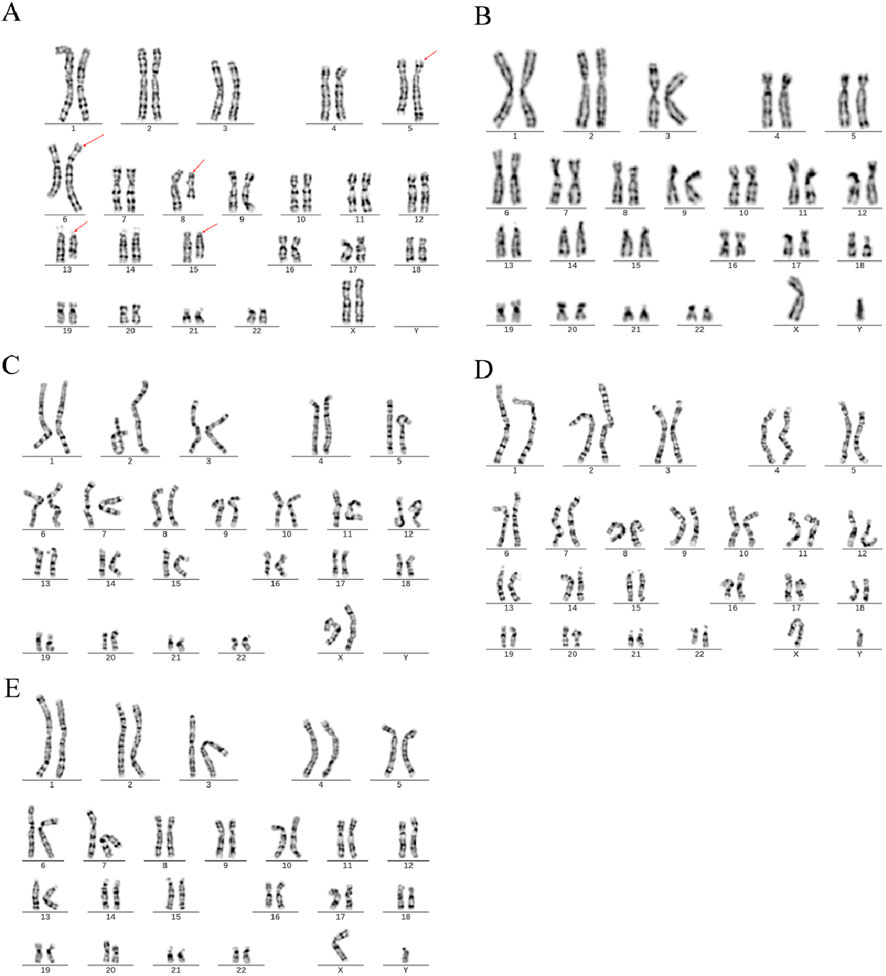 Five panels labeled A to E display karyotypes, each showing human chromosomes arranged in pairs by number. Panel A includes red arrows indicating abnormalities on chromosomes 5, 6, 9, 13, and 15. Panels B to E display normal chromosomal arrangements without markings.