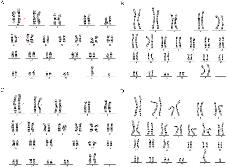 A figure presents four karyotypes labeled A, B, C, and D. Each panel displays chromosomes numbered 1 to 22, including the sex chromosomes X and Y. Panels A and C have arrows marking certain chromosomes, suggesting abnormalities or points of interest, while B and D show no such markings. The chromosomes are organized in pairs, highlighting banding patterns useful in genetic analysis.