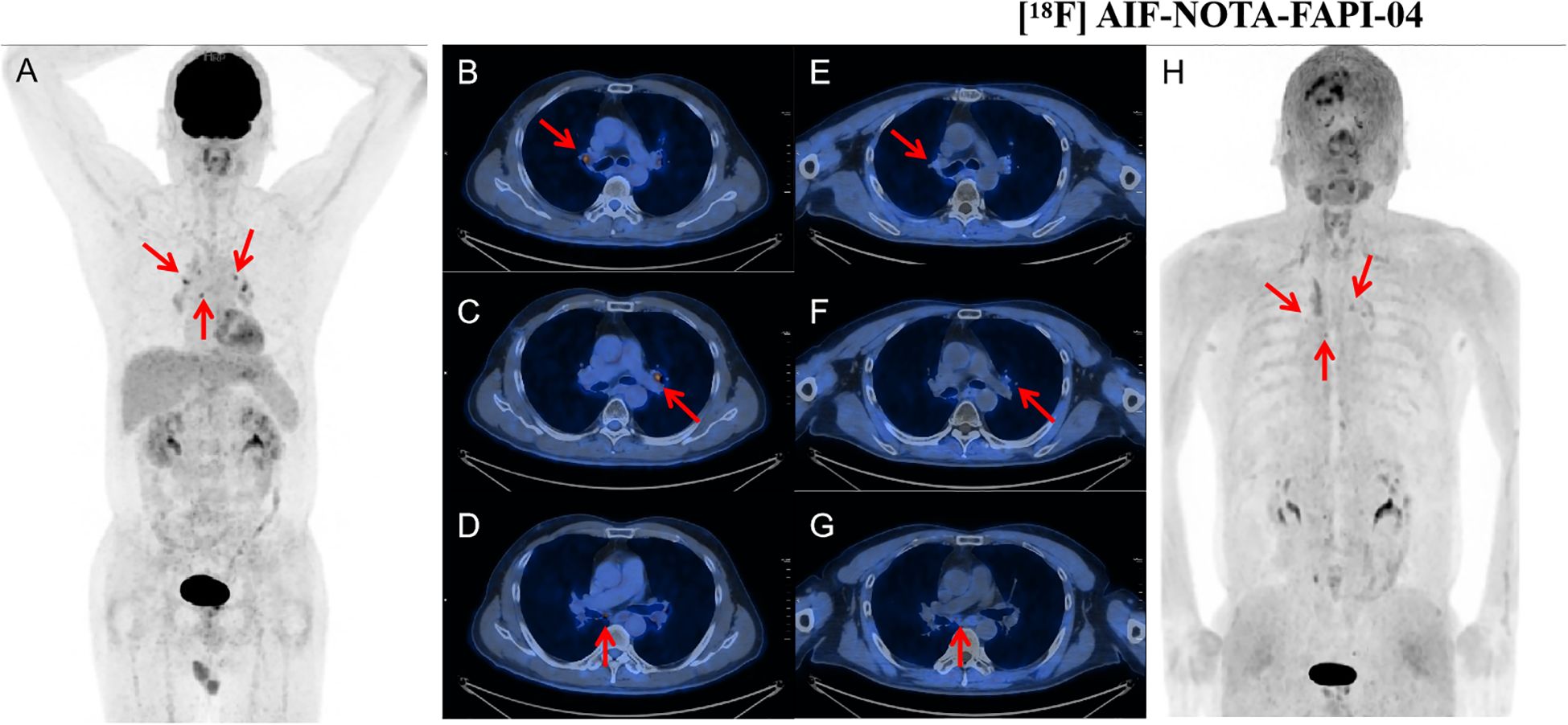 A series of medical scan images showing a full-body scan and several axial chest scans. The full-body scans on the left (A) and right (H) have red arrows indicating areas in the upper chest region. The axial chest scans (B-G) highlight specific areas within the chest, pointed out by red arrows. These scans likely illustrate areas of interest or concern, possibly related to medical diagnostics utilizing a tracer noted in the label as AIF-NOTA-FAPI-04.