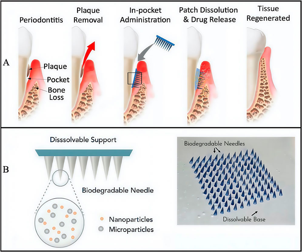 Diagram illustrating a dental treatment process for periodontitis. Section A shows five steps: periodontitis with plaque and bone loss, plaque removal, in-pocket drug administration using a patch, patch dissolution and drug release, and tissue regeneration. Section B depicts biodegradable microneedles with nanoparticles and microparticles on a dissolvable support.