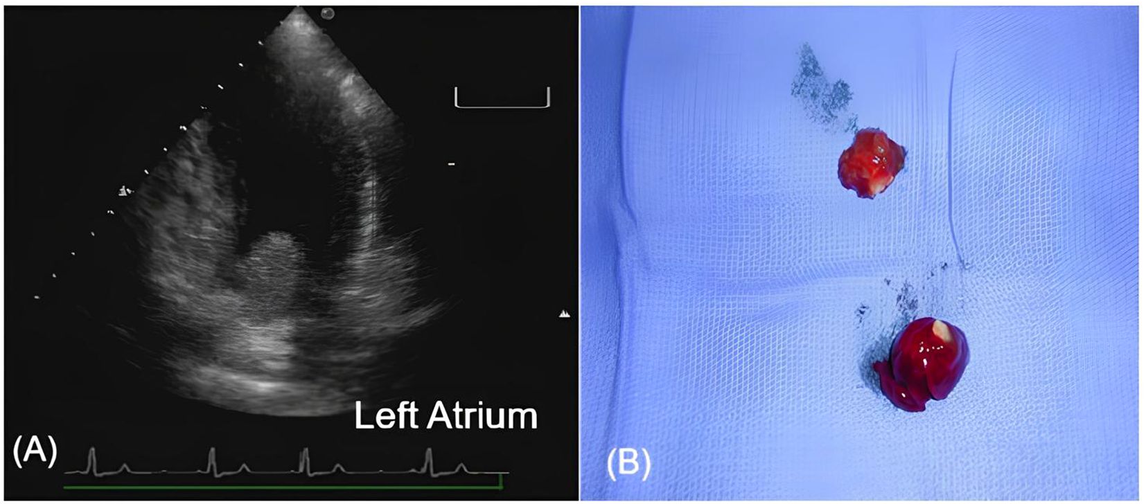 Panel A: Transthoracic echocardiogram (apical four-chamber view) showing a left atrial myxoma attached to the interatrial septum. Panel B: Gross pathological specimen of the excised cardiac myxoma.