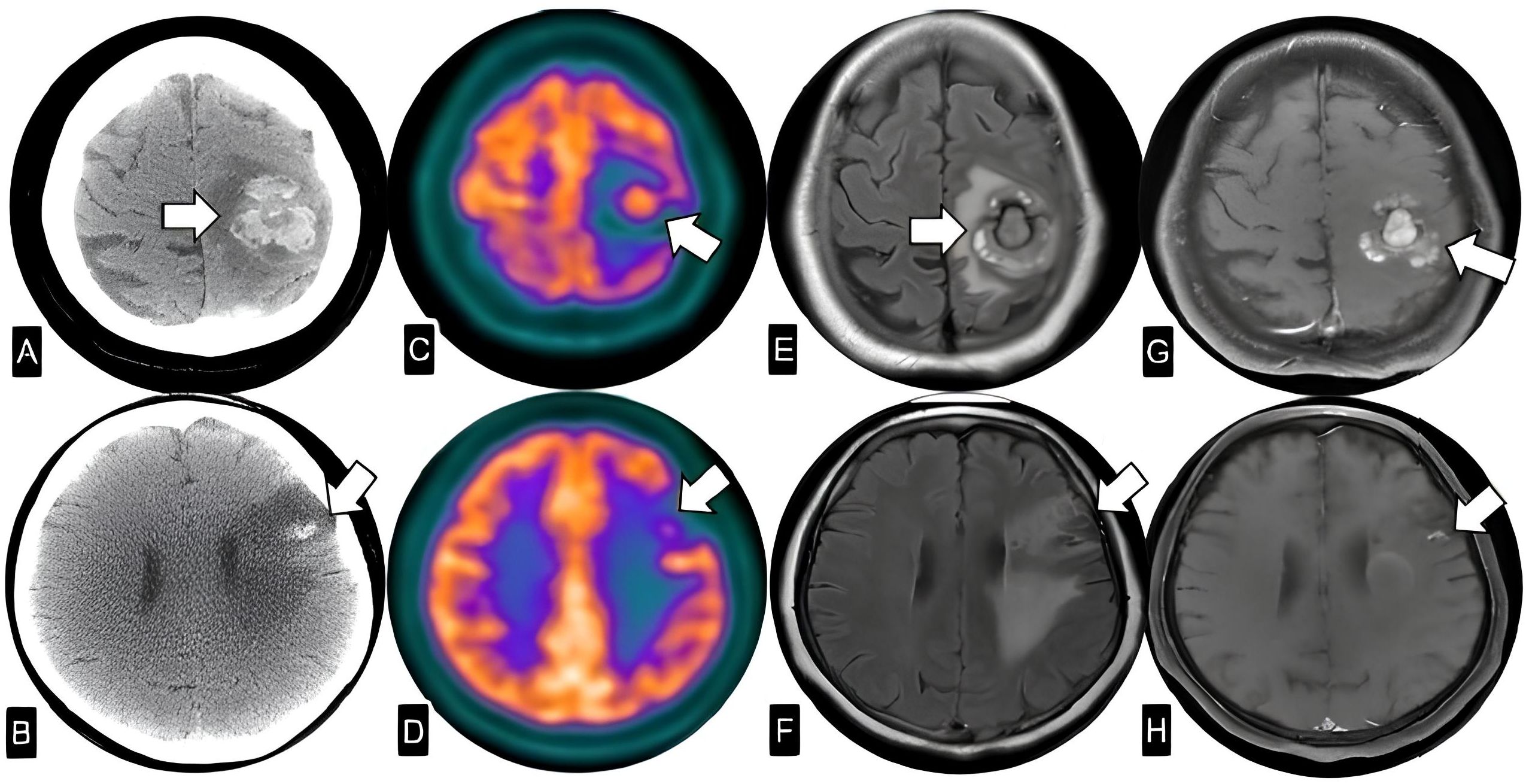 Figure showing multimodal brain imaging of a patient with suspected metastatic lesions. Panel A and B display non-enhanced CT scans showing hyperdense, hemorrhagic lesions in the left frontoparietal region. Panels C and D show fused PET/CT images with increased FDG uptake in these areas, indicating hypermetabolic activity. Panels E and F show axial T2 FLAIR MRI with expansive hyperintense lesions, while Panels G and H present axial T1-weighted post-contrast (T1-Gd) images showing lesion enhancement and signs of intralesional bleeding. Arrows point to the areas of interest. The combination of findings is suggestive of neoplastic brain involvement