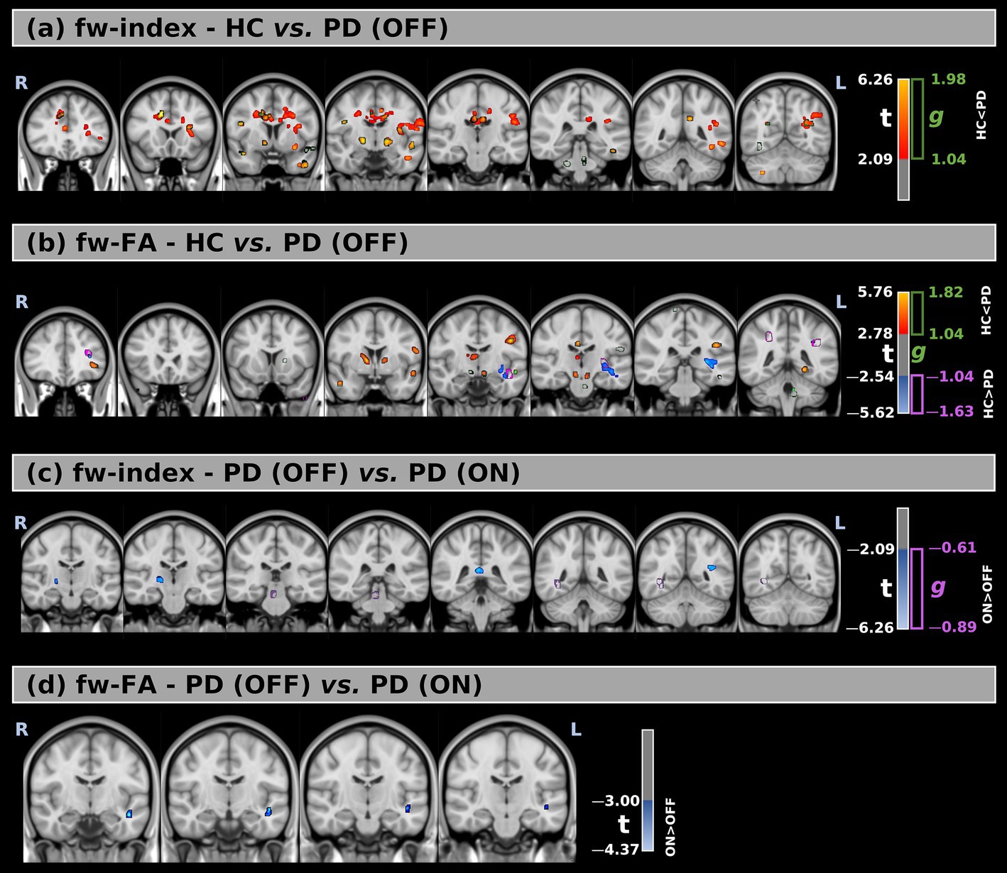 Brain imaging results displayed in four panels, labeled (a) to (d). Each panel compares different conditions using colored overlays on brain images: (a) and (b) compare HC versus PD (OFF), showing areas of significant difference; (c) and (d) compare PD (OFF) versus PD (ON). Each panel includes a color bar indicating statistical values, with different colors highlighting regions with variations between conditions.