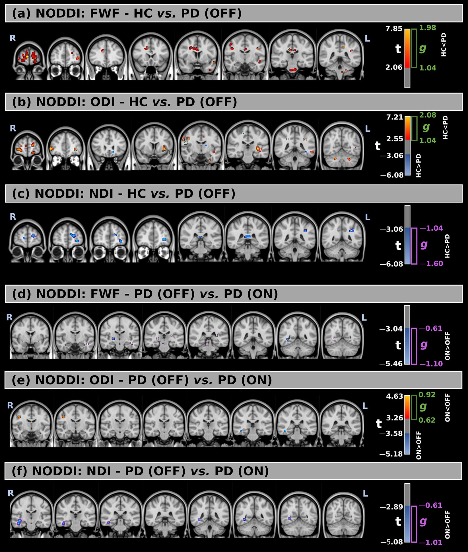 The image consists of six panels showing NODDI MRI brain scans comparing different groups: healthy controls (HC), Parkinson's Disease patients off medication (PD OFF), and on medication (PD ON). Each panel highlights various brain areas with color-coded regions indicating significant differences: (a) FWF - HC versus PD OFF, (b) ODI - HC versus PD OFF, (c) NDI - HC versus PD OFF, (d) FWF - PD OFF versus PD ON, (e) ODI - PD OFF versus PD ON, (f) NDI - PD OFF versus PD ON. Color scales beside each panel indicate statistical values.