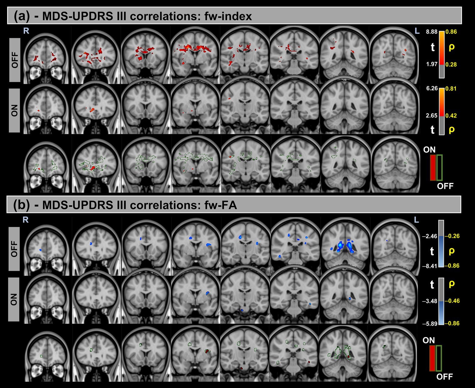 MRI brain images showing MDS-UPDRS III correlations. Panel (a) shows fw-index correlations with red areas indicating off state and green areas on state. Panel (b) displays fw-FA correlations with blue areas for off state and green areas for on state. Both panels include color scales indicating t-values and correlation coefficients.