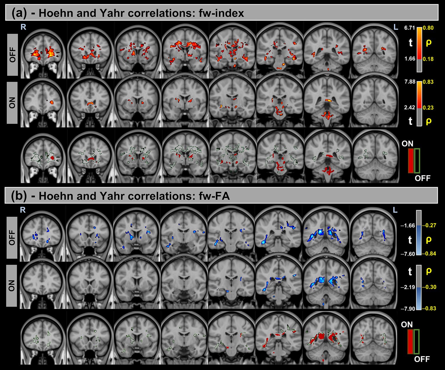 Brain MRI scans showing Hoehn and Yahr correlation analyses. (a) Displays fw-index in red tones, with differences between OFF and ON states marked. Color keys indicate statistical measures (t) and significance (ρ).(b) Shows fw-FA in blue tones, with OFF and ON differences marked similarly. Both images include legends for right (R), left (L), ON, and OFF states, with bar scales for values.