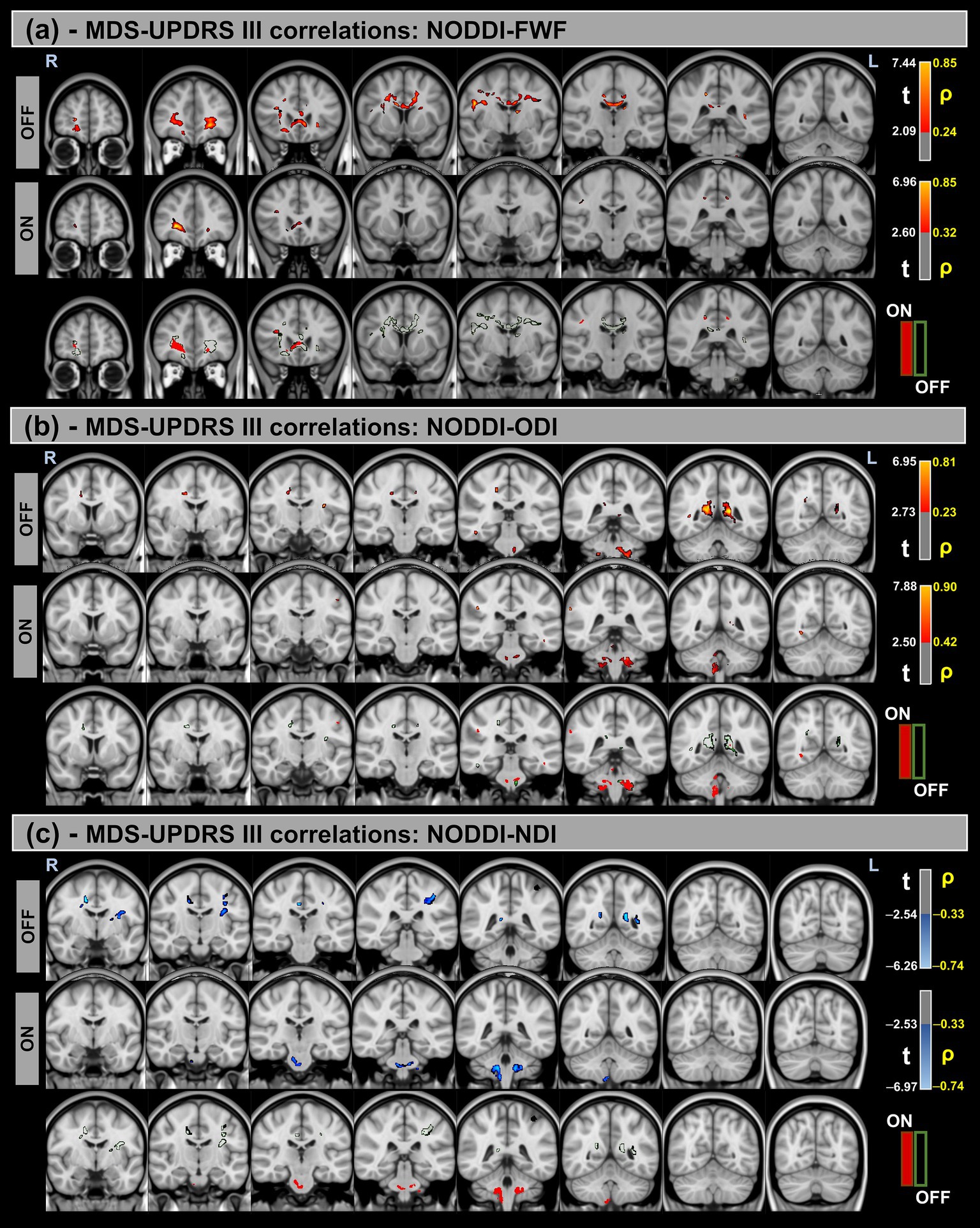 Three panels of brain images illustrating MDS-UPDRS III correlations with NODDI parameters: (a) FWF, (b) ODI, and (c) NDI. Each panel presents correlational differences in Parkinson's disease patients under ON and OFF conditions. Images include t-value scales and p-value significance markers. The brain sections are shown in various coronal slices highlighting relevant regions with colored overlays.