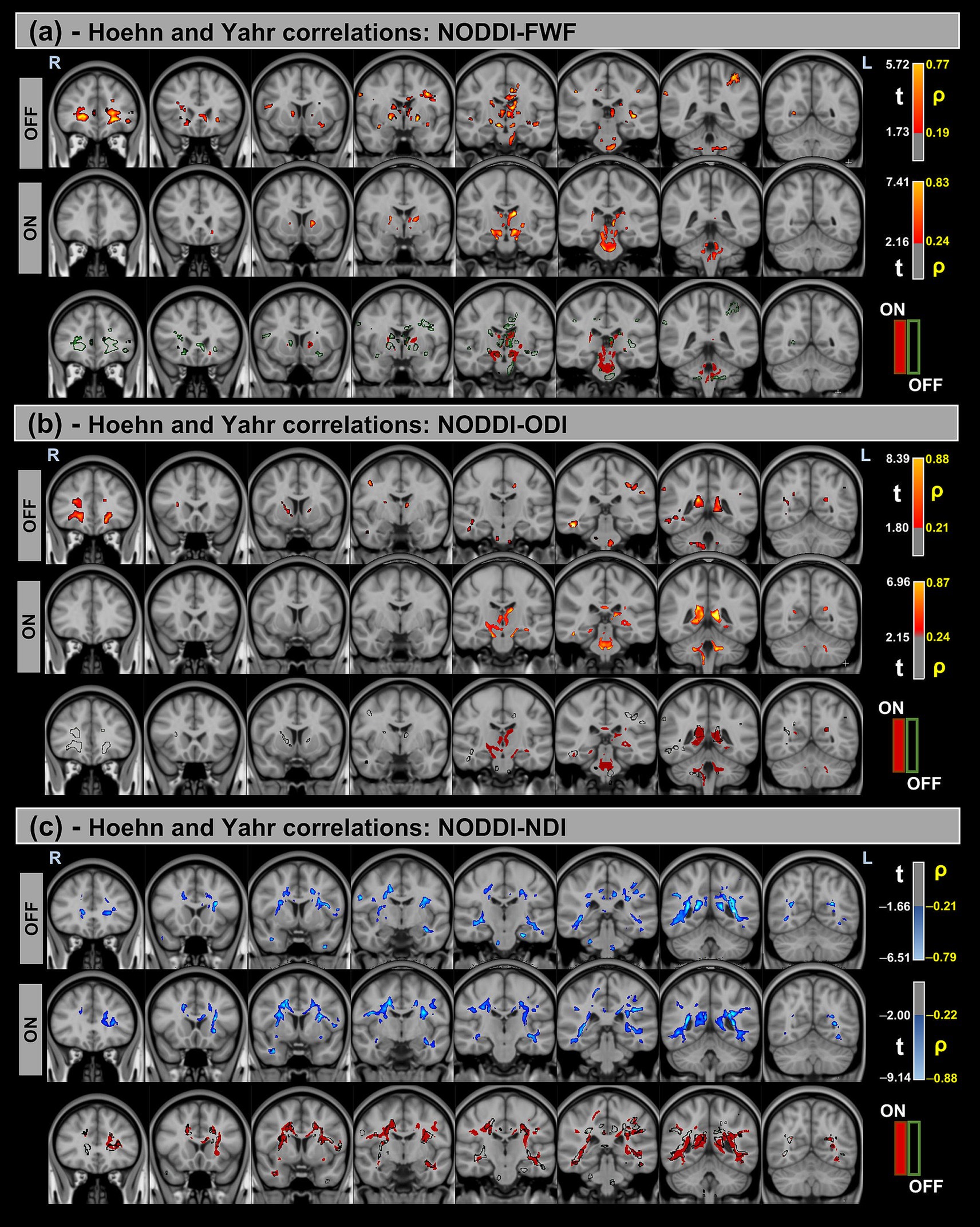 MRI brain scans divided into three sections: (a) NODDI-FWF, (b) NODDI-ODI, and (c) NODDI-NDI, showing Hoehn and Yahr correlations. Each section compares