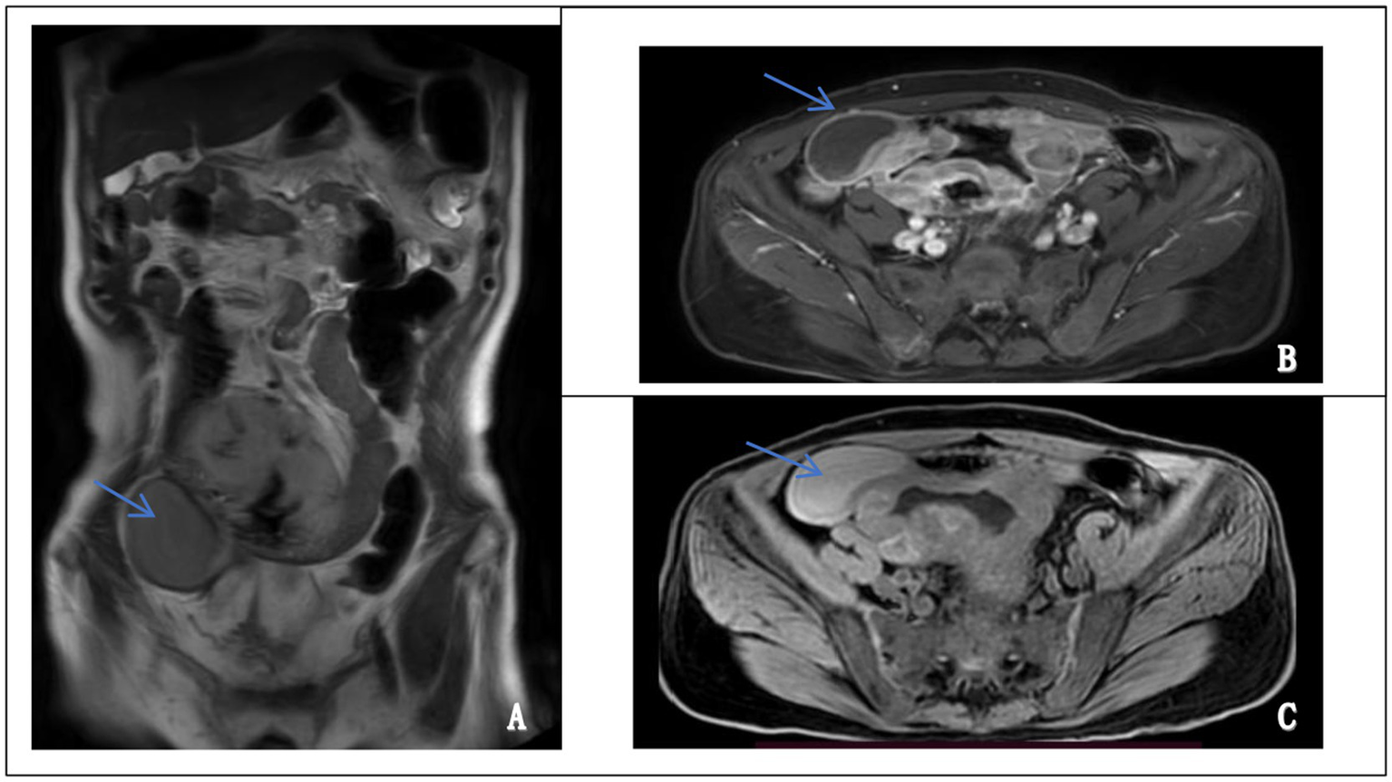 Three MRI scans labeled A, B, and C show different views of a pelvic area. In each image, an arrow points to a specific area within the pelvis. Image A displays a coronal view, while images B and C show axial views, highlighting a region of interest.