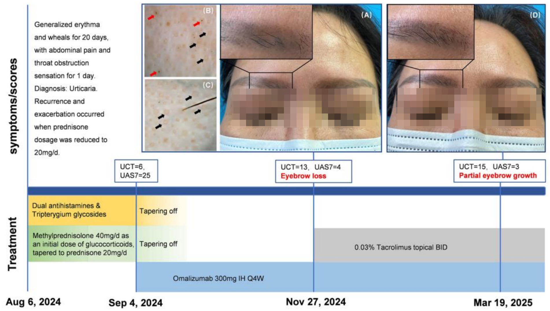 Clinical images and treatment timeline for a case of urticaria with eyebrow loss and regrowth. Images (A) and (D) show eyebrow condition at different stages. Insets (B) and (C) display dermoscopic views. The timeline details symptoms, scores, and treatments including antihistamines, glucocorticoids, omalizumab, and topical tacrolimus over several months.
