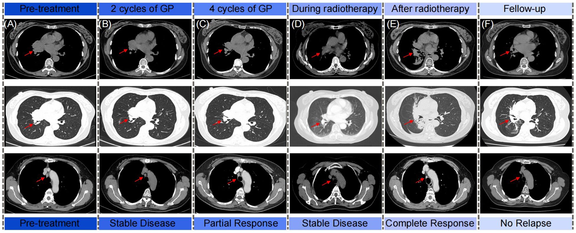 CT scans show a patient's treatment progression over six stages: pre-treatment, after two and four cycles of GP chemotherapy, during and after radiotherapy, and during follow-up. Each row highlights lung changes with red arrows indicating tumor location. The scans demonstrate the stages labeled as pre-treatment, stable disease, partial response, complete response, and no relapse across the timeline.