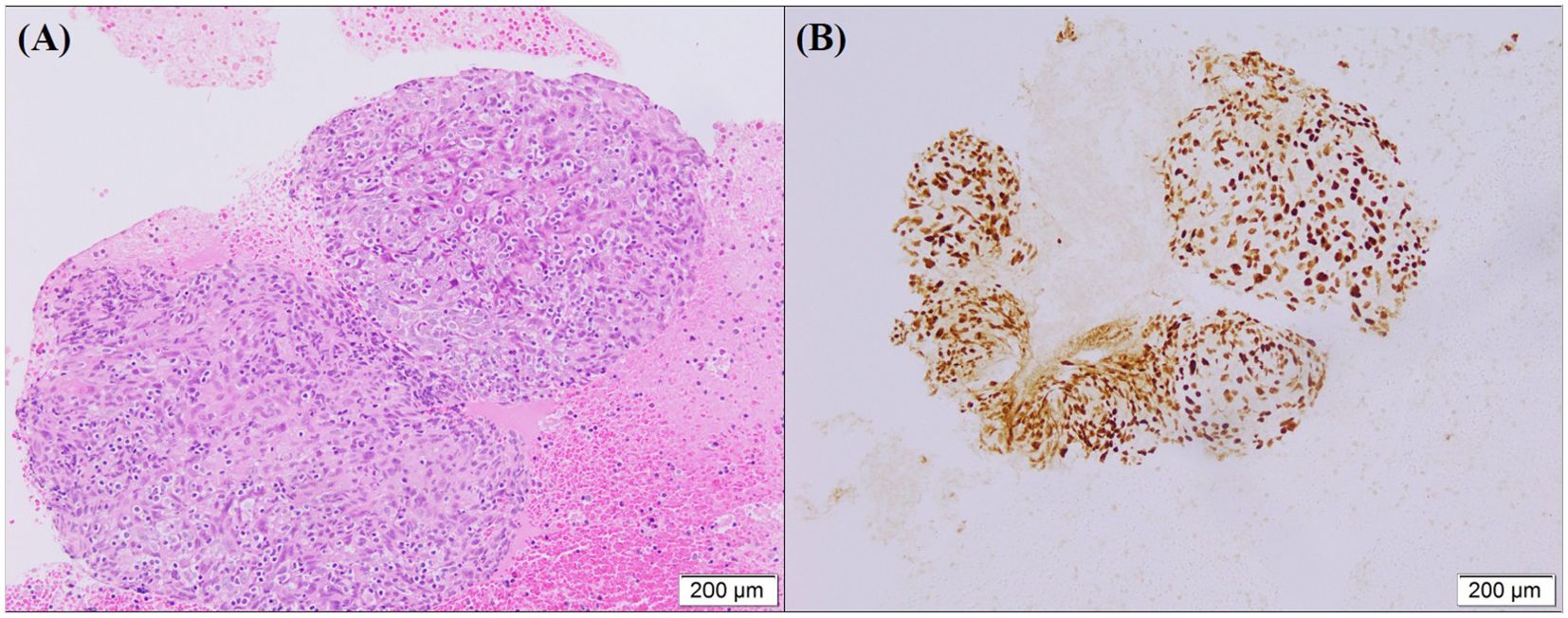 Two microscopic images labeled A and B. Image A shows a tissue section stained in pink and purple, highlighting cell nuclei and cytoplasm. Image B demonstrates a brown staining, indicating areas of protein expression. Both images are marked with a scale bar of two hundred micrometers.