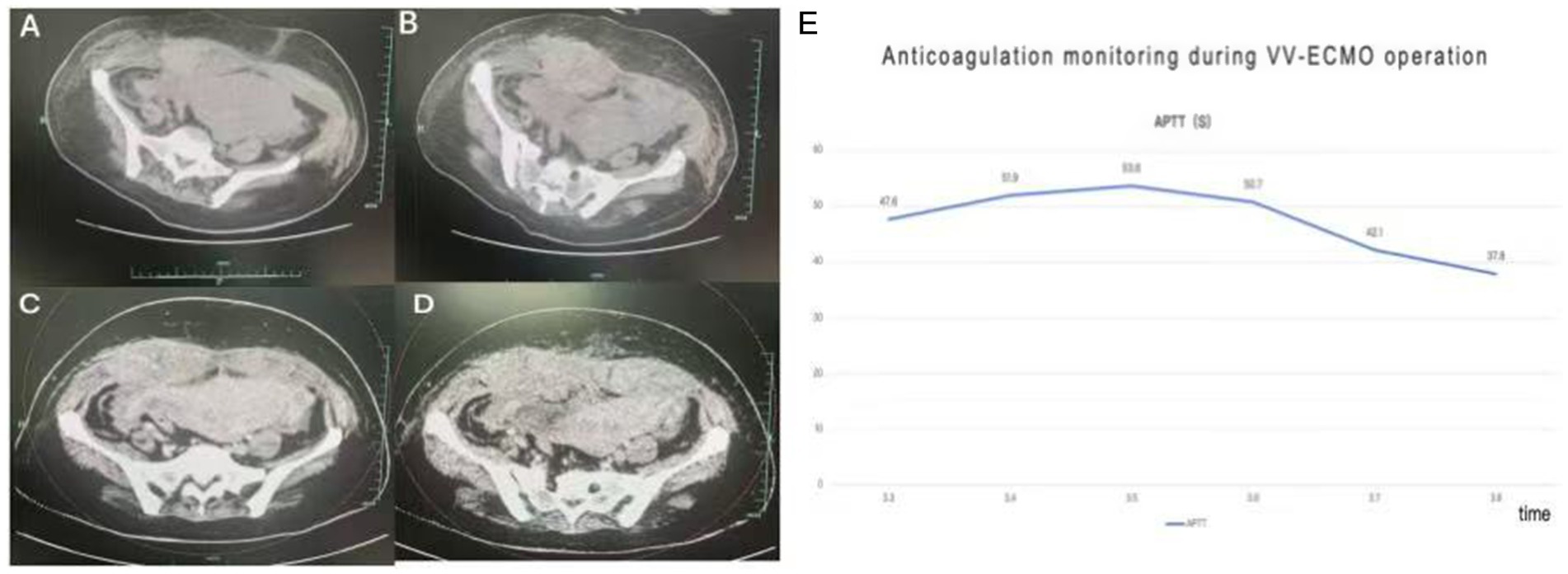 Four-panel image with CT scans labeled A, B, C, and D showing different abdominal views, alongside a line graph. The graph, titled
