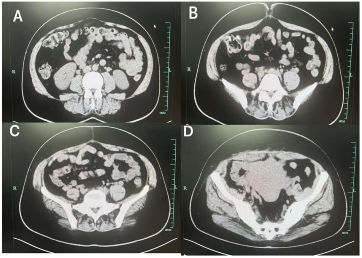 CT scan images labeled A to D show cross-sectional views of the abdomen. Each scan displays different levels, depicting various organs and anatomical structures in grayscale. The images are arranged in a two-by-two grid, with a ruler on the right side indicating scale.