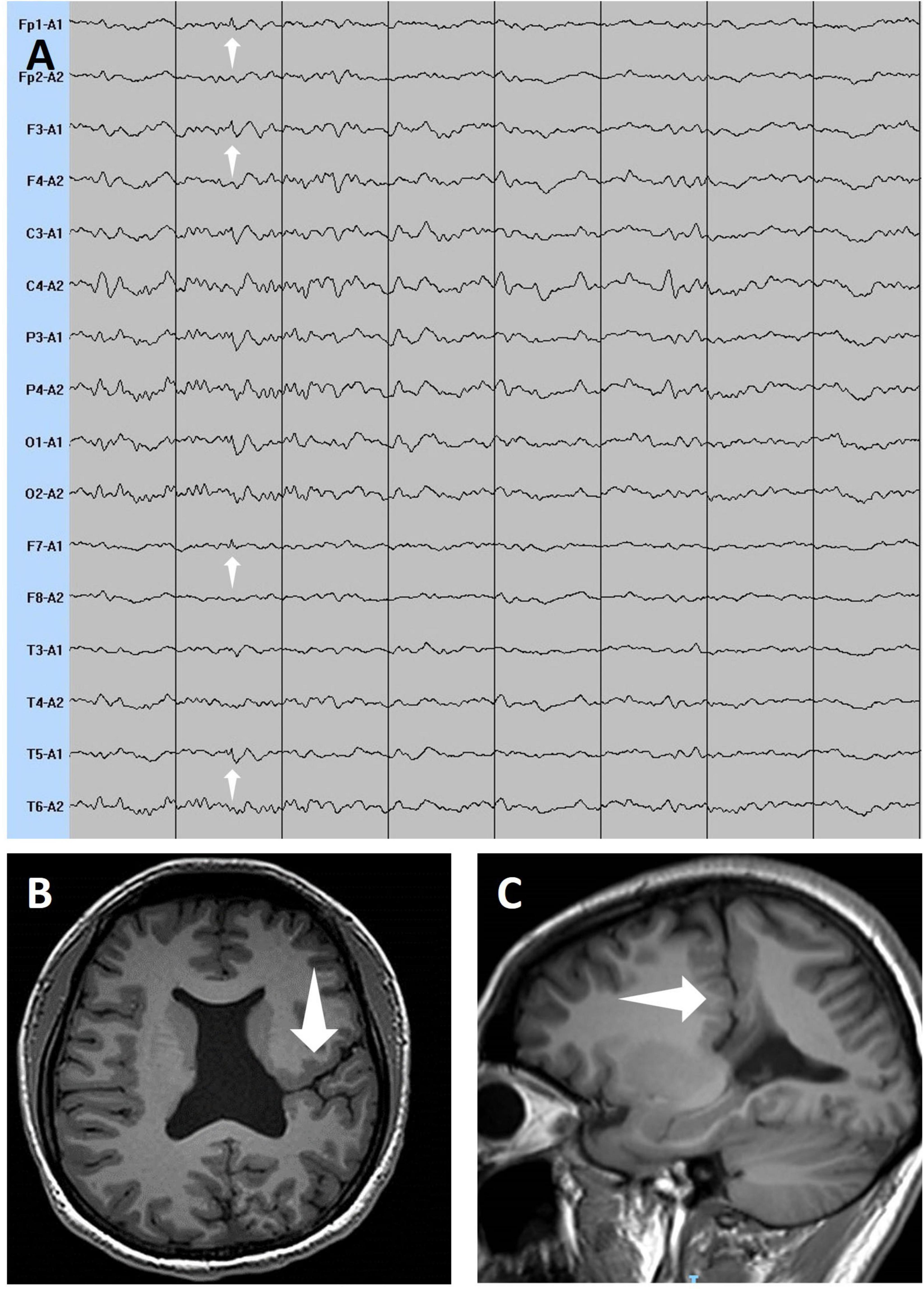 Panel A displays EEG readings with several channels labeled from Fp1-A1 to T6-A2, showing varying wave patterns. White arrows indicate specific waveform features. Panel B is a coronal brain MRI image showing a highlighted region, with an arrow pointing toward the lateral ventricle. Panel C features a sagittal brain MRI with an arrow pointing to the corpus callosum area.