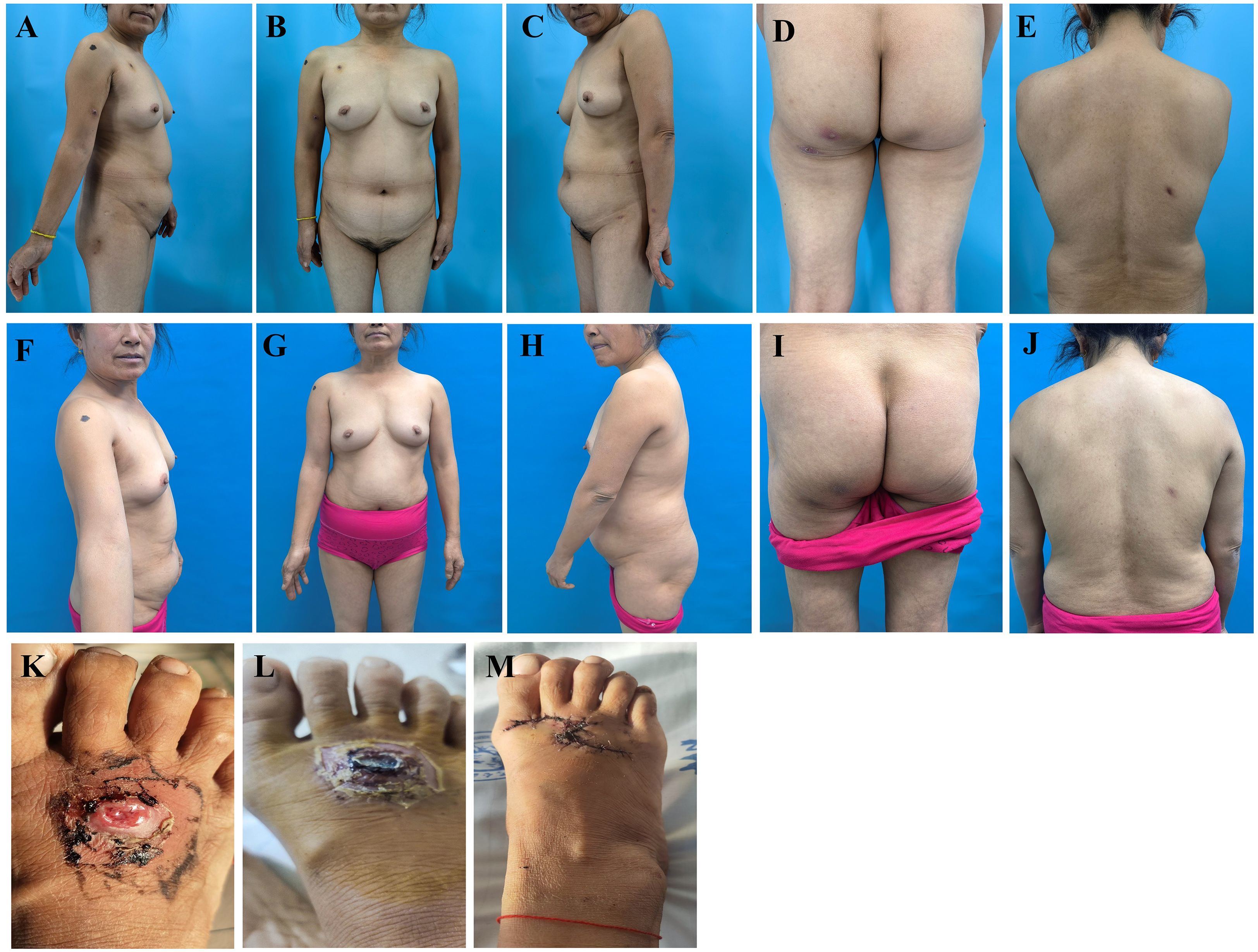 A series of images labeled A to M showing different angles of an adult female's body, with close-ups of a foot wound. Images A to E and F to J display full-body profiles from various angles, highlighting skin and body features. Images K to M focus on a foot with a healing wound, showing different stages of the healing process.
