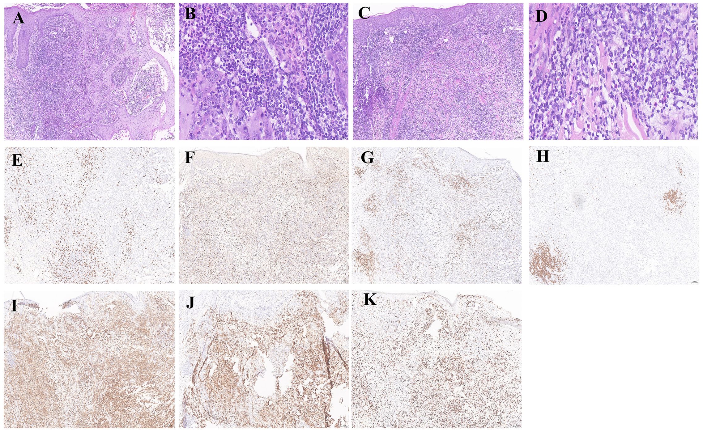 Microscopic images showing a series of tissue samples under different staining techniques. Panels A and C display lower magnification images showing tissue architecture with cellular structures. Panels B and D provide close-up views of densely-packed cells. Panels E to K showcase immunohistochemical staining patterns, with varying degrees of brown staining indicating different protein expressions across the samples.