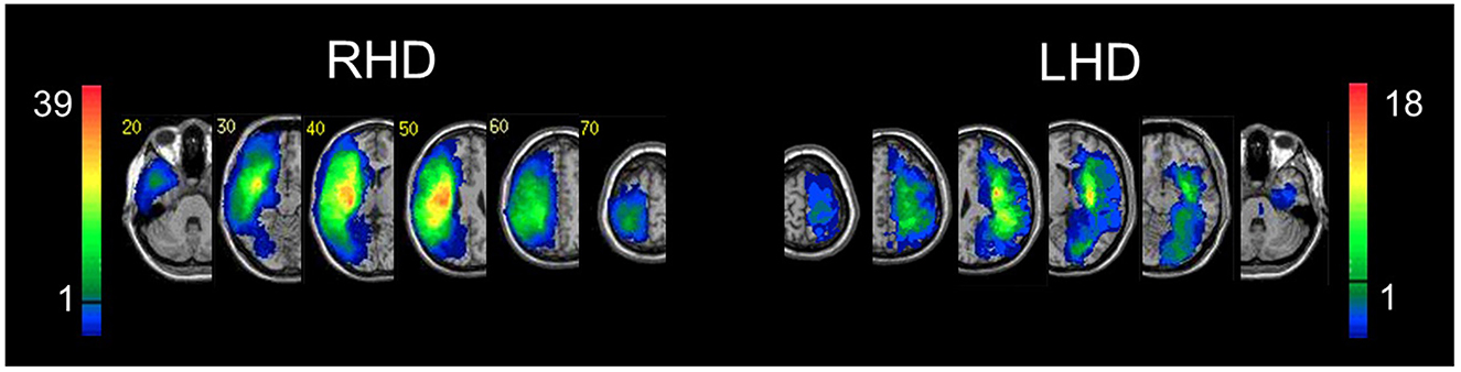 Lesion overlay images showing normalized brain slices for right hemisphere damage (RHD) and left hemisphere damage (LHD). Voxels included in the maps are those damaged in at least 10% of patients. Color-coded scales indicate the number of patients with damage in each voxel, with a horizontal line marking the inclusion threshold. Slice numbers are shown, and displays follow the radiological convention (right hemisphere shown on the left).