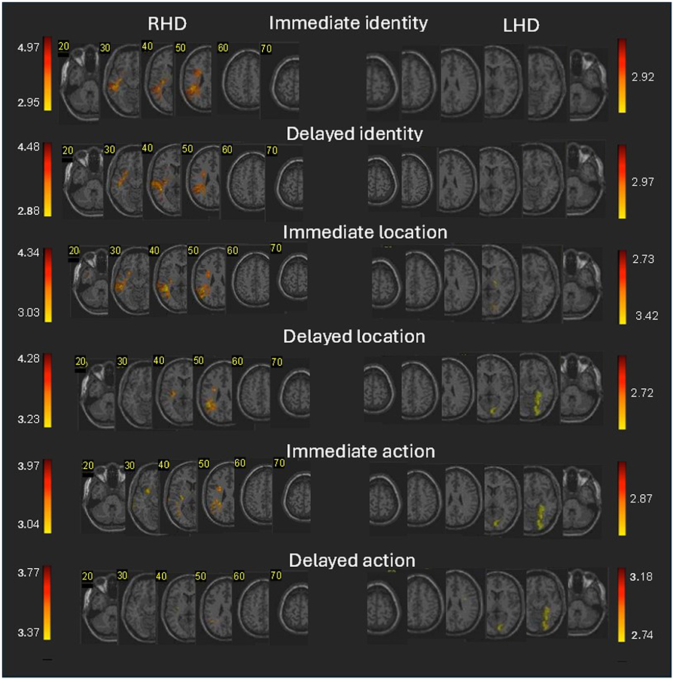 Voxel-based lesion-behavior mapping (VLSM) images comparing RHD and LHD groups for immediate and delayed memory of identity, location, and action. Only voxels damaged in at least 10% of patients were analyzed; significant clusters surpass z>2.6 (p < 0.005). Color scales indicate z-score magnitude, with warmer colors showing higher scores. Slice numbers are indicated, and displays follow radiological convention.