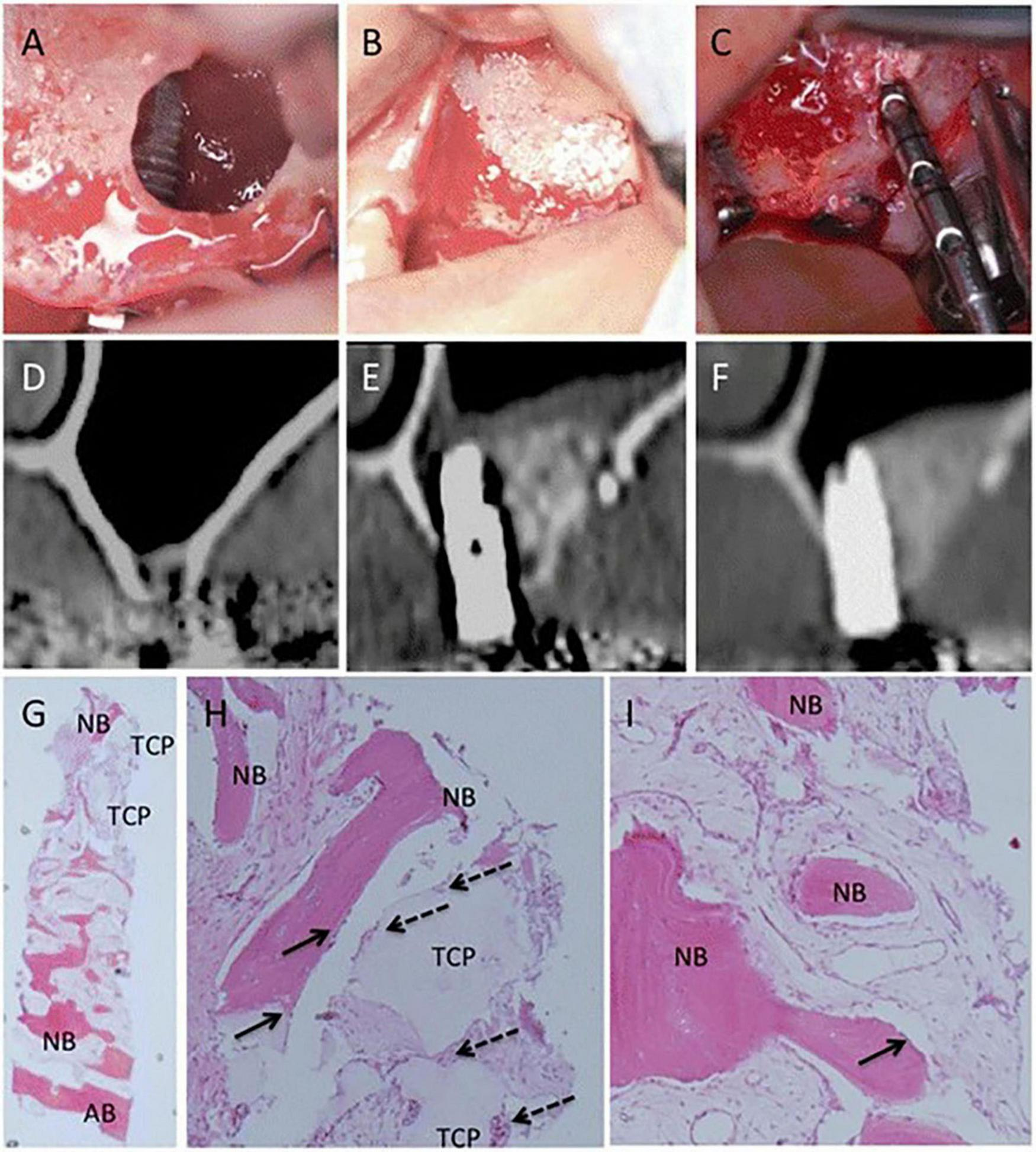A series of images showing a dental surgical procedure and histological analysis. Images A-C depict various stages of the surgery involving implantation and bone grafting. Images D-F are CT scans showing the graft’s integration over time with the bone. Images G-I are histological slides stained to reveal new bone formation (NB), bone graft material (TCP), and original bone (AB), showing the integration and development of new bone tissue.