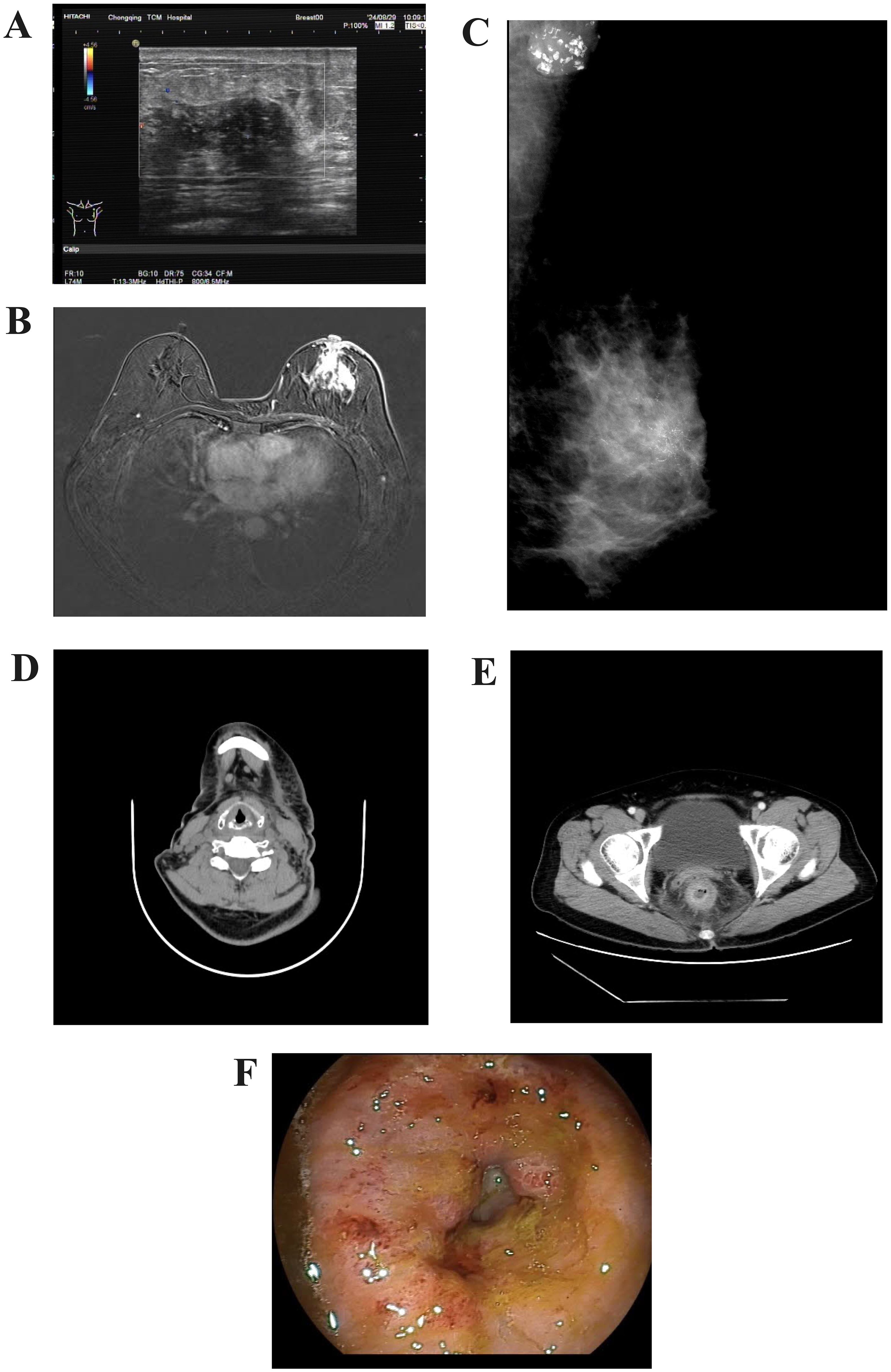 Panel A shows an ultrasound image with a dark irregular mass. Panel B displays an MRI scan, revealing a prominent area. Panel C is a mammogram with dense tissue. Panel D depicts a head CT scan, highlighting the lower jaw area. Panel E presents a pelvic CT scan with visible bone structures. Panel F is an endoscopic view showing inflamed mucosa with lesions.