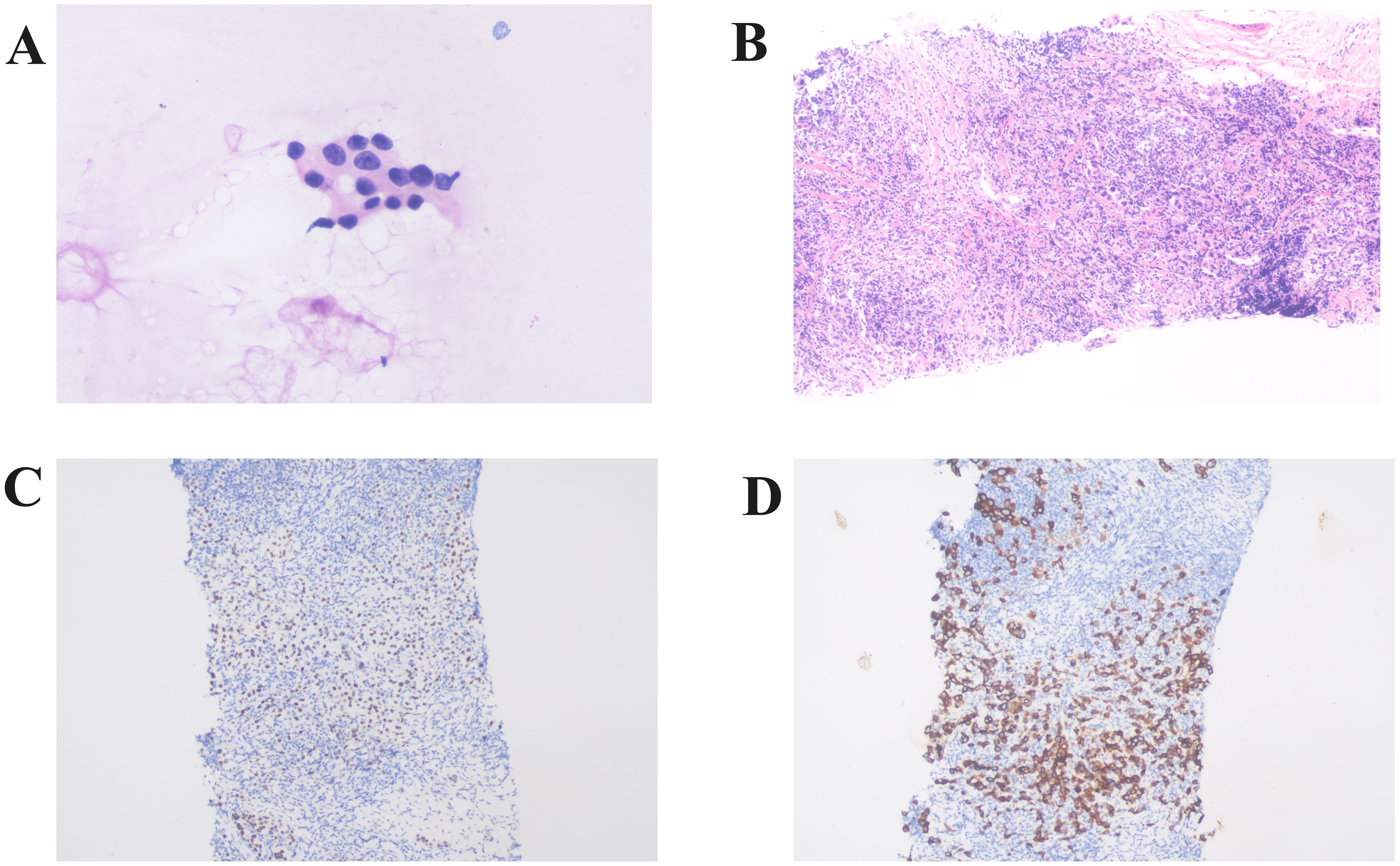 Histological analysis of tissue sections. A: Cluster of cells with dark nuclei on a light pink background. B: Dense tissue with abundant dark purple staining. C: Thin section stained with blue, scattered darker cells. D: Similar section with more pronounced brown-stained areas indicating different cellular components.