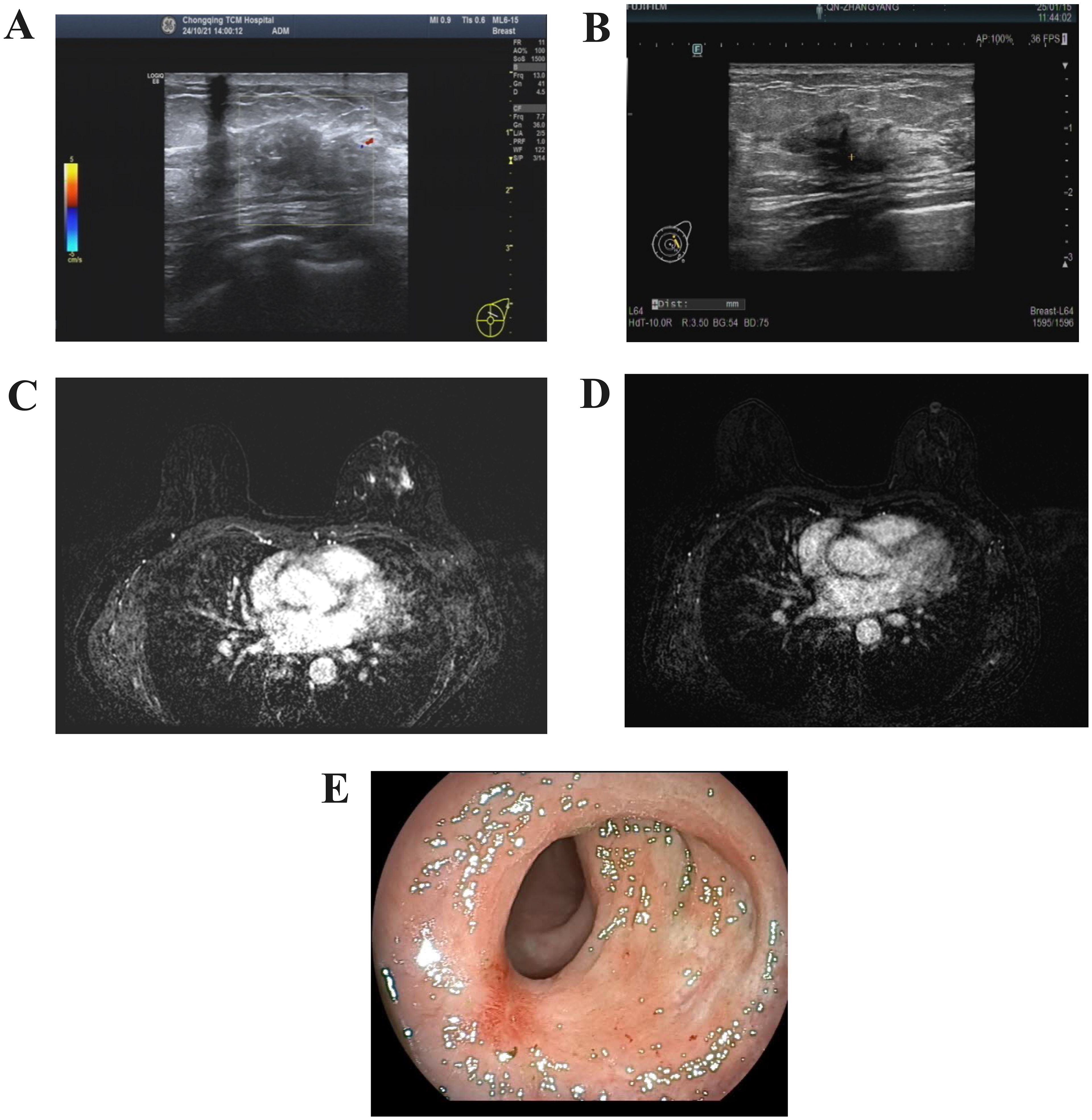 A series of medical images labeled A to E. Image A shows a breast ultrasound with color mapping. Image B is a grayscale ultrasound image of breast tissue. Images C and D depict MRI scans of breast tissue, highlighting areas of high signal intensity. Image E presents an endoscopic view of the interior of a digestive tract, showing a smooth, pinkish lining with some light reflections.