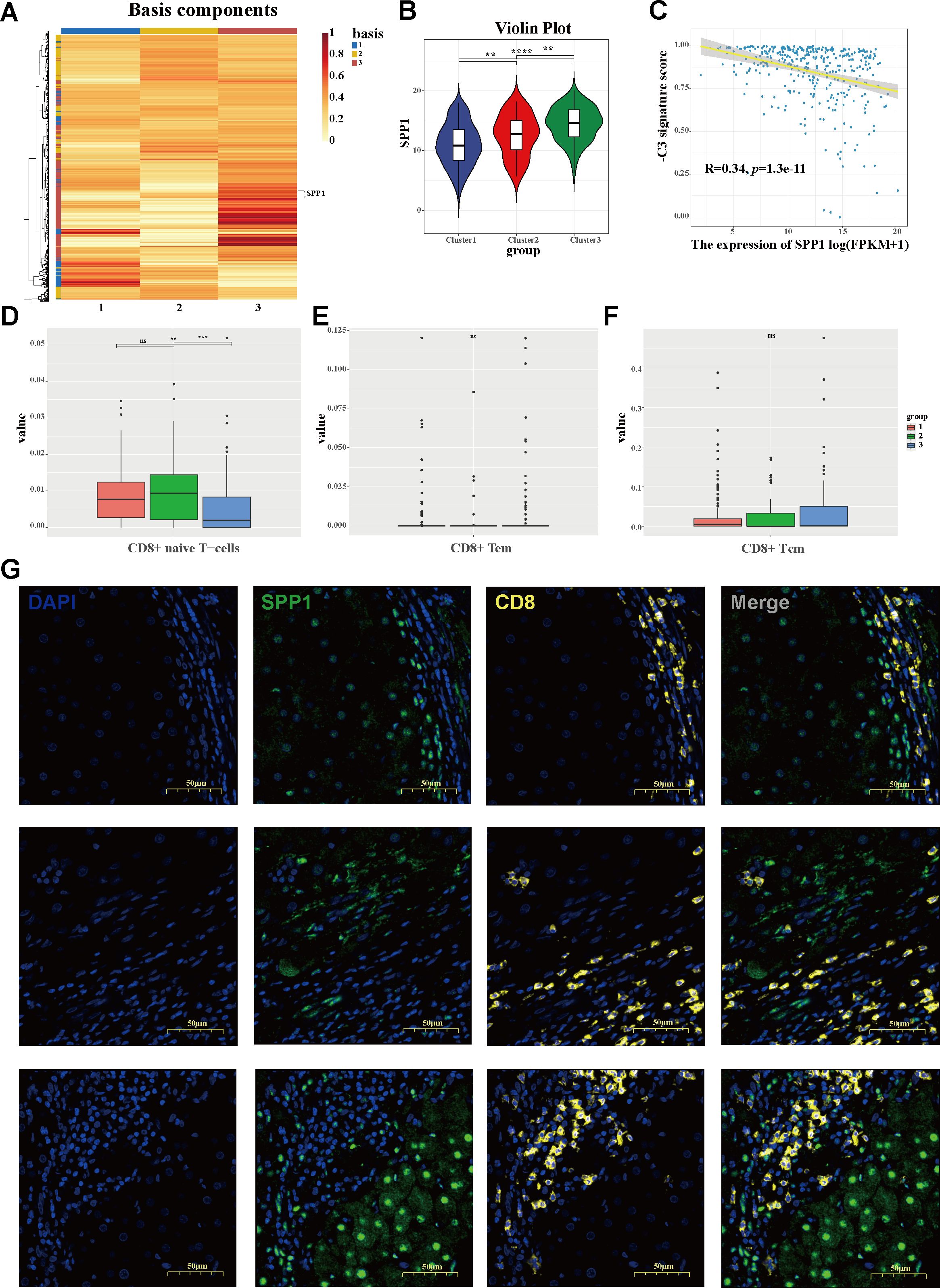 A series of scientific visualizations and microscopy images relating to SPP1 expression. A: Heatmap showing basis components clustered into three groups. B: Violin plot displaying SPP1 expression across three clusters, highlighting significant differences. C: Scatter plot illustrating a negative correlation between SPP1 expression and GZ signature score. D-F: Box plots presenting data distribution for CD8+ naive T-cells and CD8+ Tem across different groups. G: Microscopy images showing staining of DAPI, SPP1, CD8, and merged views, indicating cellular localization and distribution. Each image is labeled and features scale bars for reference.
