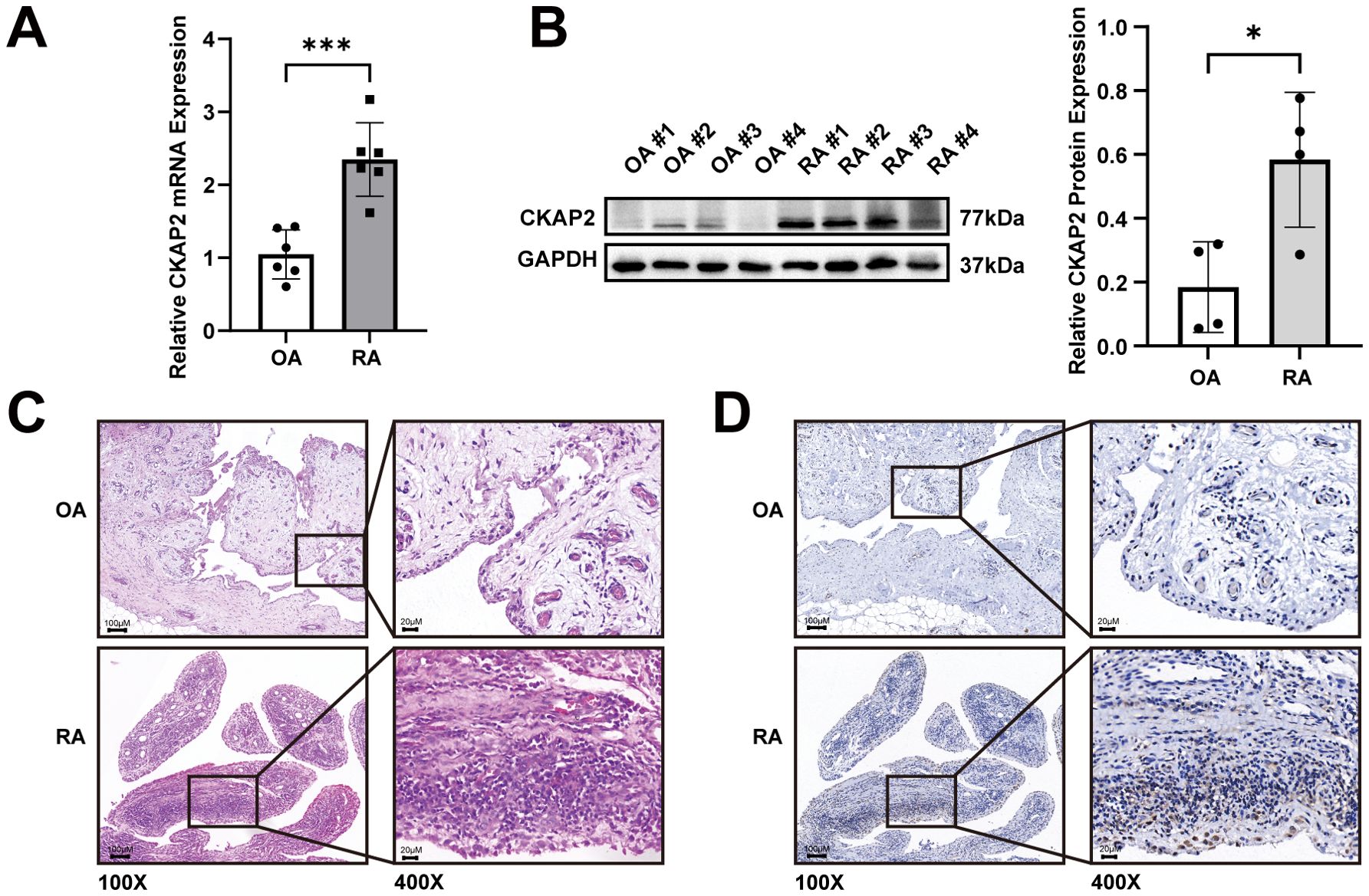 (A) Bar graph showing CKAP2 mRNA expression in OA and RA, with RA significantly higher. (B) Western blot of CKAP2 and GAPDH, with a bar graph indicating higher CKAP2 protein expression in RA. (C) Histological images at 100X and 400X magnification for OA and RA showing tissue differences. (D) Immunohistochemical staining images at 100X and 400X magnification for OA and RA, highlighting increased staining in RA.