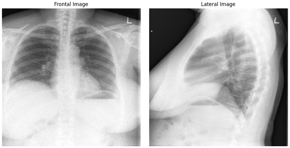Chest X-ray showing two views: a frontal image on the left and a lateral image on the right. Both images display the ribcage, lungs, and heart, with normal anatomical features visible.