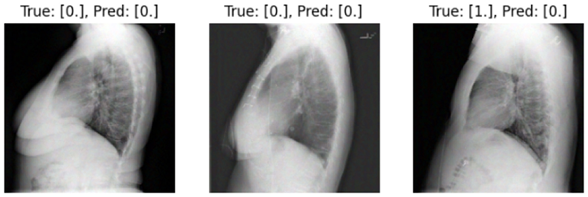 Three side-view chest X-rays are presented. The first two images are labeled with a true and predicted value of zero, indicating likely normal findings. The third image shows a true value of one and a predicted value of zero, suggesting a potential misdiagnosis.