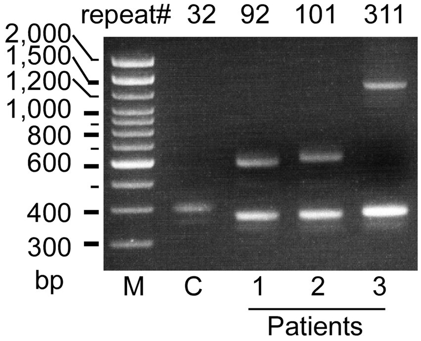 Gel electrophoresis image showing DNA bands for marker (M), control (C), and three patient samples labeled 1, 2, and 3. Band sizes range from 300 to 2,000 base pairs (bp). Bands indicate repeat numbers: 32, 92, 101, and 311 for corresponding samples.