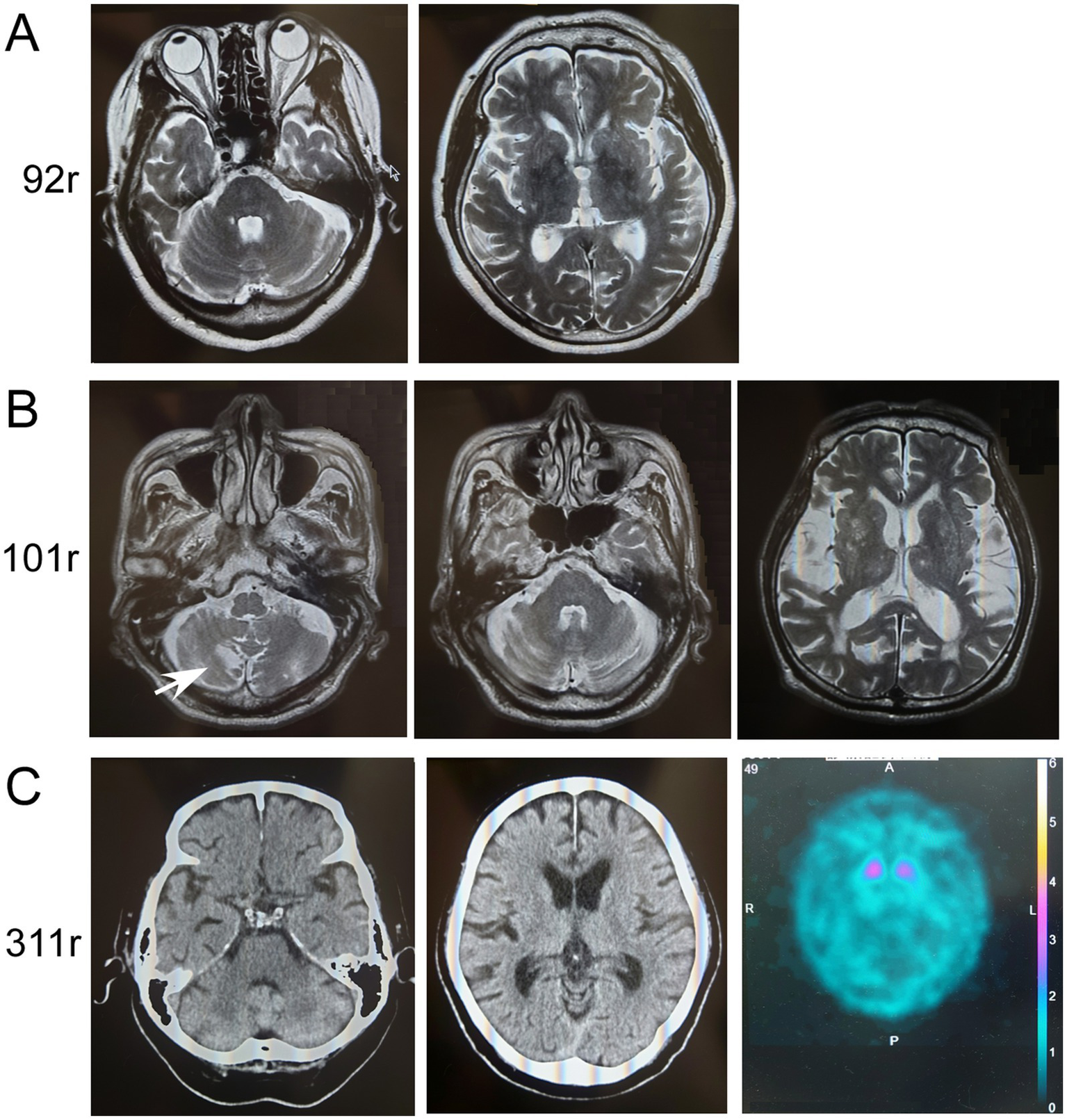 Grouped medical images showing brain scans. Section A includes two axial MRI scans labeled 92r. Section B features three MRI scans labeled 101r, with one highlighted by an arrow. Section C displays two CT scans labeled 311r and a colorful SPECT scan with a numeric scale.