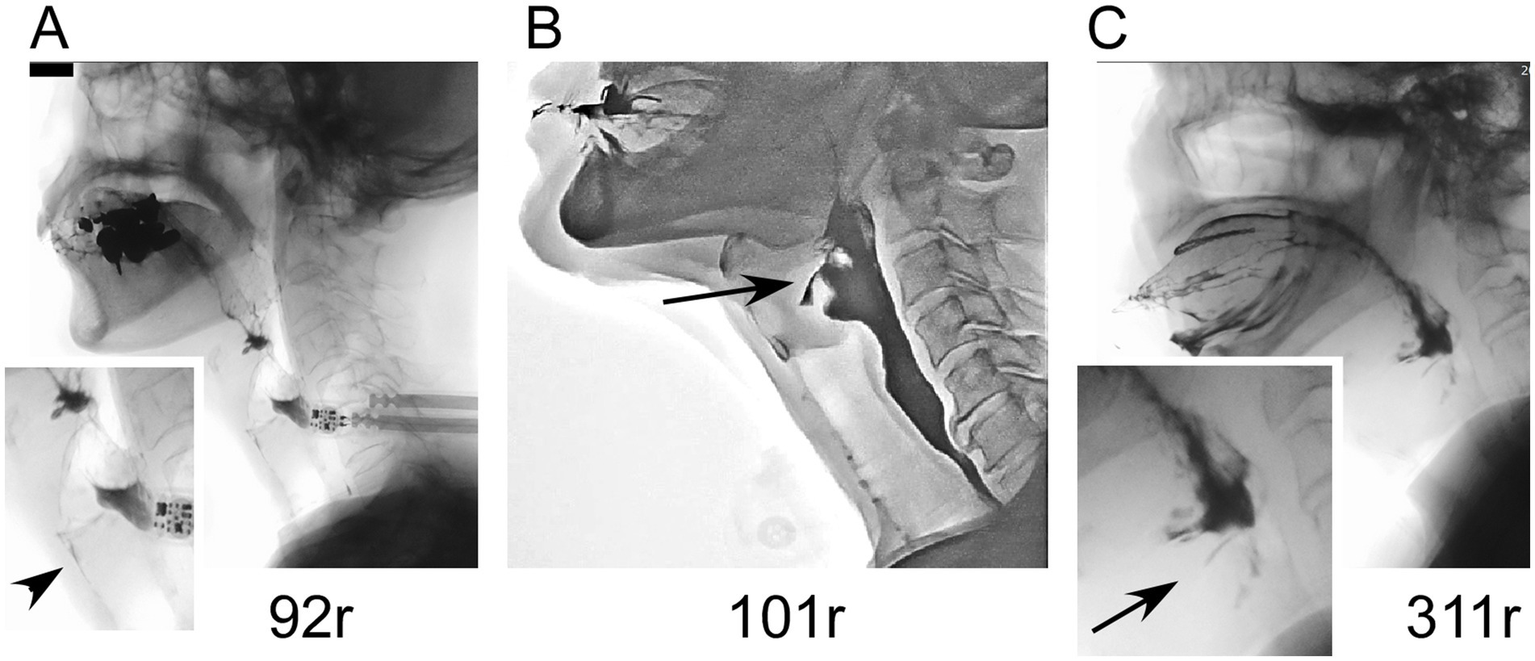 Three radiographic images labeled A, B, and C, showing side views of throat and neck anatomy. Panel A features a dark area near the mouth and an enlarged inset. Panel B highlights a marked arrow pointing to the pharynx. Panel C shows a textured structure with an inset depicting dark markings.