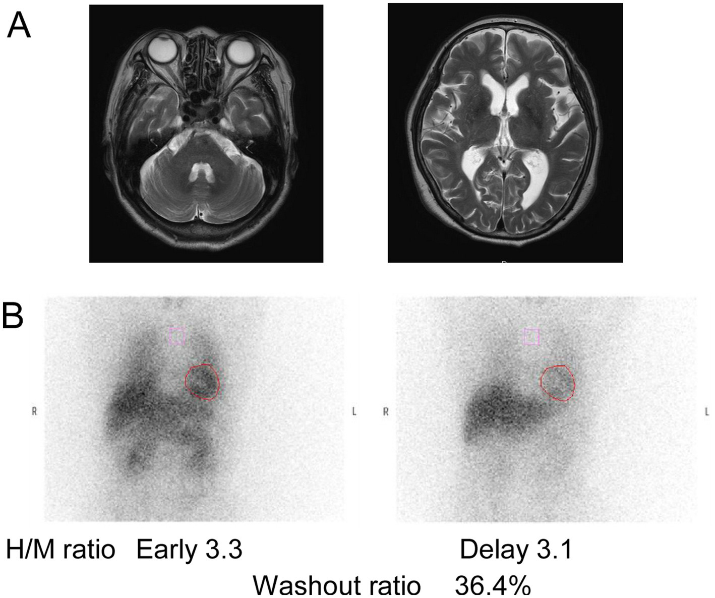 Panel A shows two MRI scans of the brain, displaying cross-sectional views with details of brain structures. Panel B depicts two diagnostic images with highlighted regions, indicating measurements of heart-to-mediastinum ratios: early ratio 3.3, delay ratio 3.1, and a washout ratio of 36.4%.