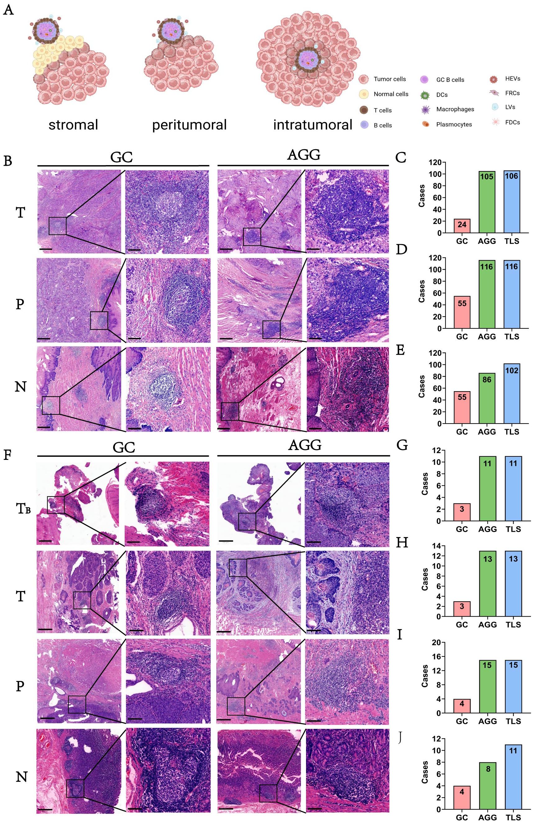 Illustration and charts detailing tumor microenvironments, comparing stromal, peritumoral, and intratumoral areas. Histological images show tissue samples for GC and AGG across various regions. Bar graphs depict case counts for different conditions. Detailed legends help distinguish cell types and regions.