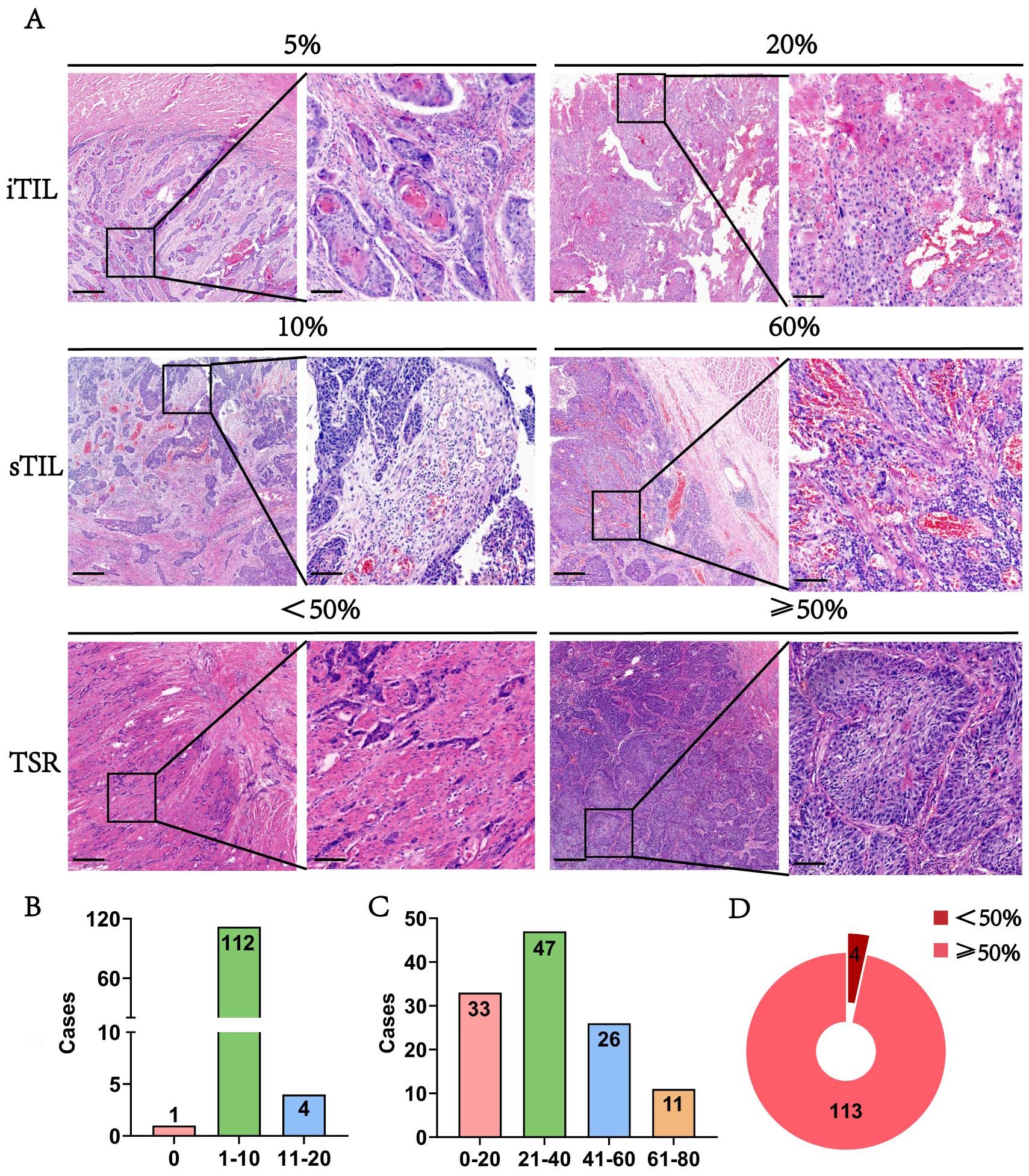 Panel A shows histopathological images with varying percentages of tumor-infiltrating lymphocytes (TILs), including iTIL at 5% and 20%, sTIL at 10% and 60%, and TSR with less than 50% and more than or equal to 50%. Panels B and C display bar charts of case distribution across different percentage ranges, with B showing ranges 0, 1-10, and 11-20, and C showing 0-20, 21-40, 41-60, and 61-80. Panel D presents a pie chart indicating case distribution where less than 50% has 113 cases and more than 50% has 4 cases.