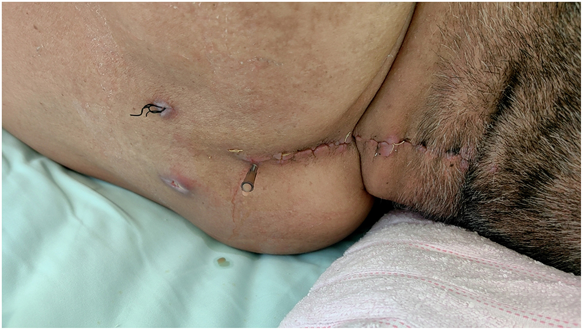 A close-u p view of a postoperative incision on a person's body, showing sutures and a drain tube. The skin around the area appears to have healed partially, with redness and some swelling visible near the incision line. The photo is taken in a medical setting, likely during a recovery period.