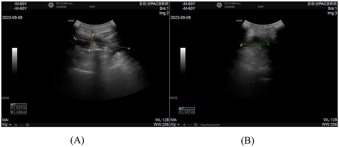 Ultrasound image showing internal body structures with two yellow measurement markers indicating dimensions. The top left corner displays patient and technical information, including date and time. Grayscale adjustment bars are visible.