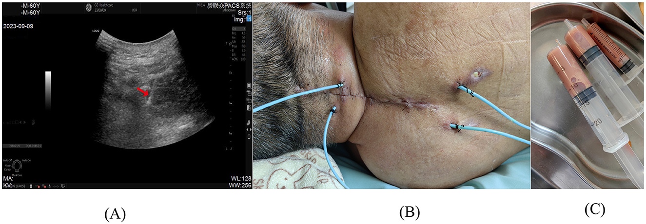 Ultrasound image displaying neck region with a highlighted measurement line indicating a length of 4.57 centimeters. The screen shows patient information and scan details in the top left corner, with grayscale and image settings visible along the edges.