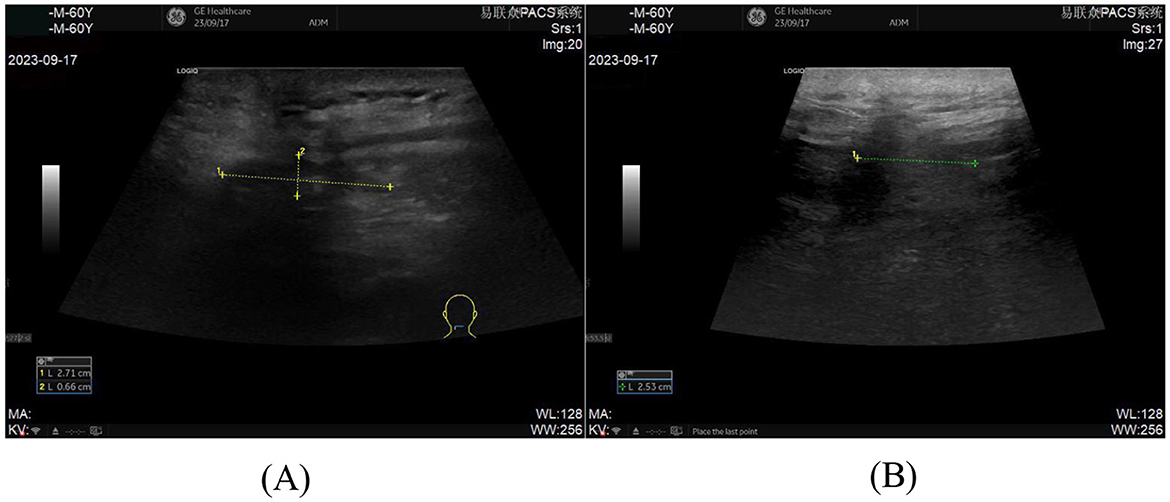 Ultrasound images labeled (A) and (B). Image (A) shows a measurement of a structure with dimensions 2.71 cm by 0.66 cm. Image (B) displays a measurement of a structure 2.53 cm in length. Both images are from the same source, dated 2023-09-17.