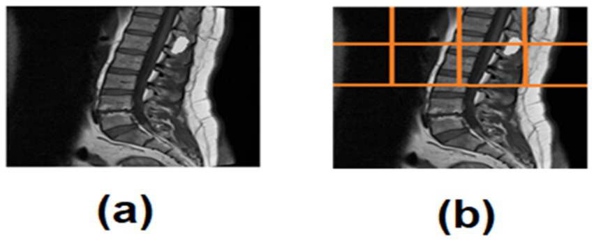 MRI scan of a spinal column shown in two panels. Panel (a) displays a clear side view of the spine. Panel (b) includes an overlay grid with orange lines, dividing the same side view into sections.