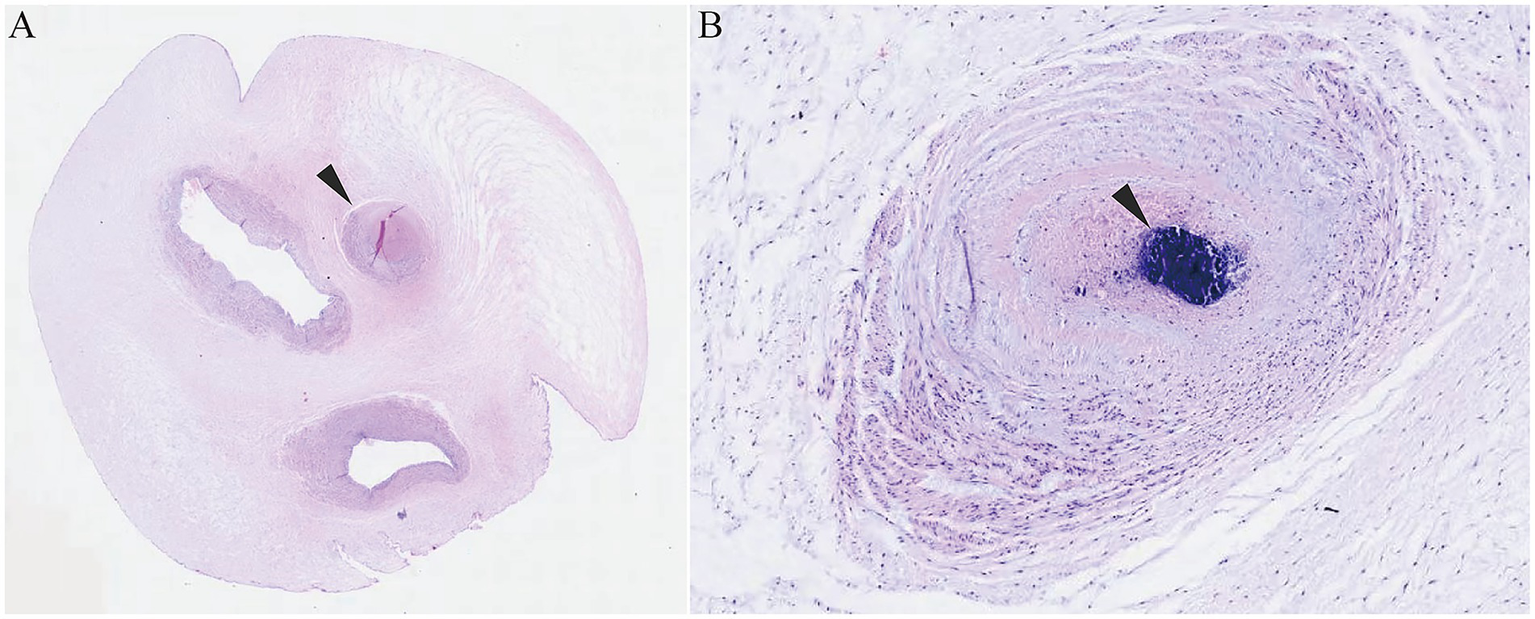 Histopathology of umbilical cord: A) Three vascular lumens with arrow marking anoccluded umbilical artery. B) Hematoxylin-stained section showing thrombosed lumen(black arrow) and collapsed vascular wall.