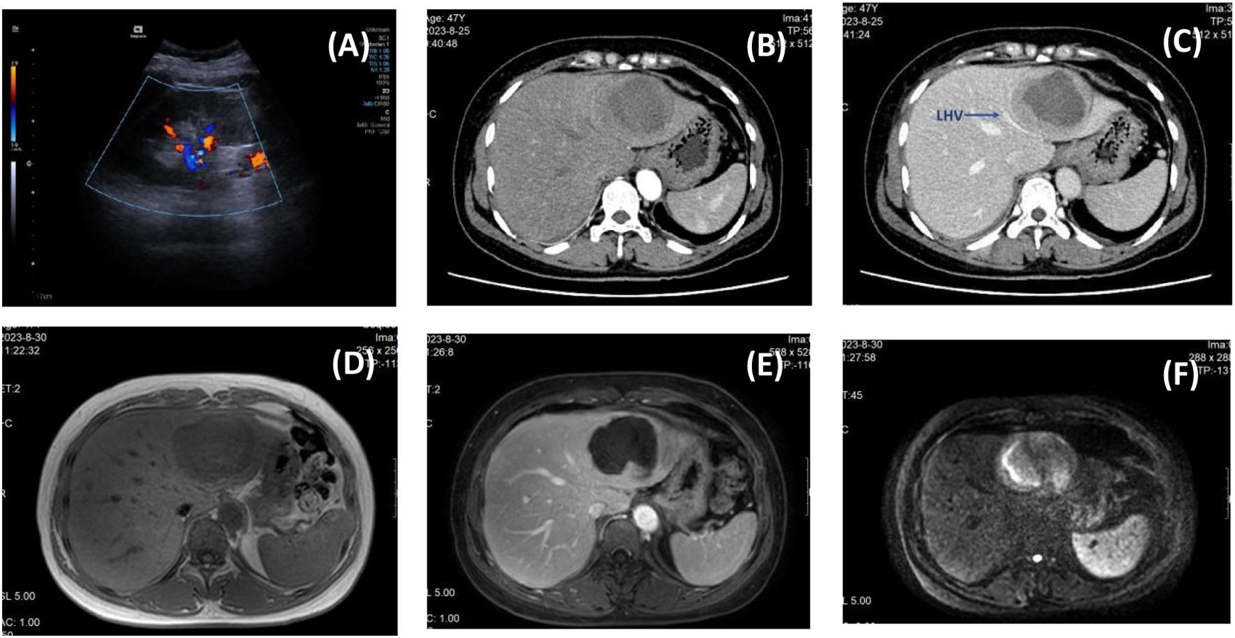 Panel (A) shows an ultrasound image with color Doppler highlighting blood flow. Panels (B) and (C) display CT scans of the abdomen, with the liver and surrounding organs visible in grayscale; panel (C) has a label indicating the left hepatic vein (LHV). Panels (D), (E), and (F) are MRI scans, presenting different tissue contrasts and anatomical structures within the abdomen, including distinct liver characteristics.