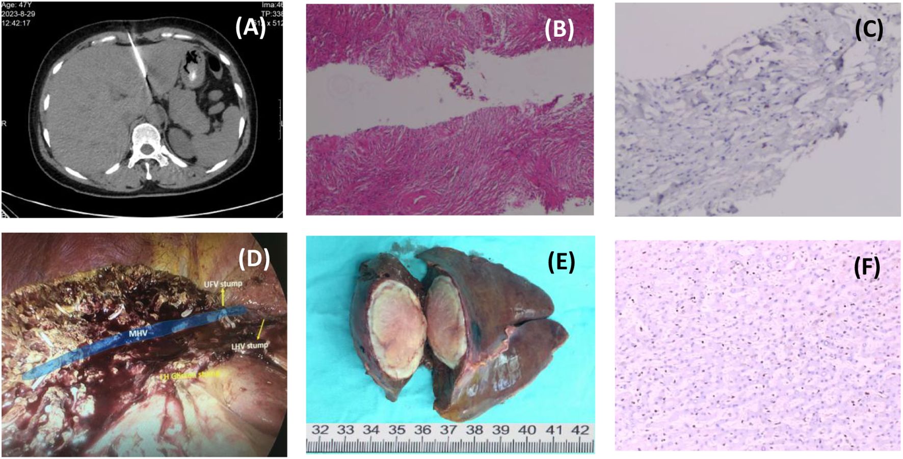CT scan showing a needle inserted into the liver (A). Histological liver tissue stained pink (B) and blue (C). Intraoperative view showing liver anatomy with labeled vessels and stumps (D). Excised liver showing a sectioned surface with a measuring scale (E). Histology slide with liver cells stained pink (F).